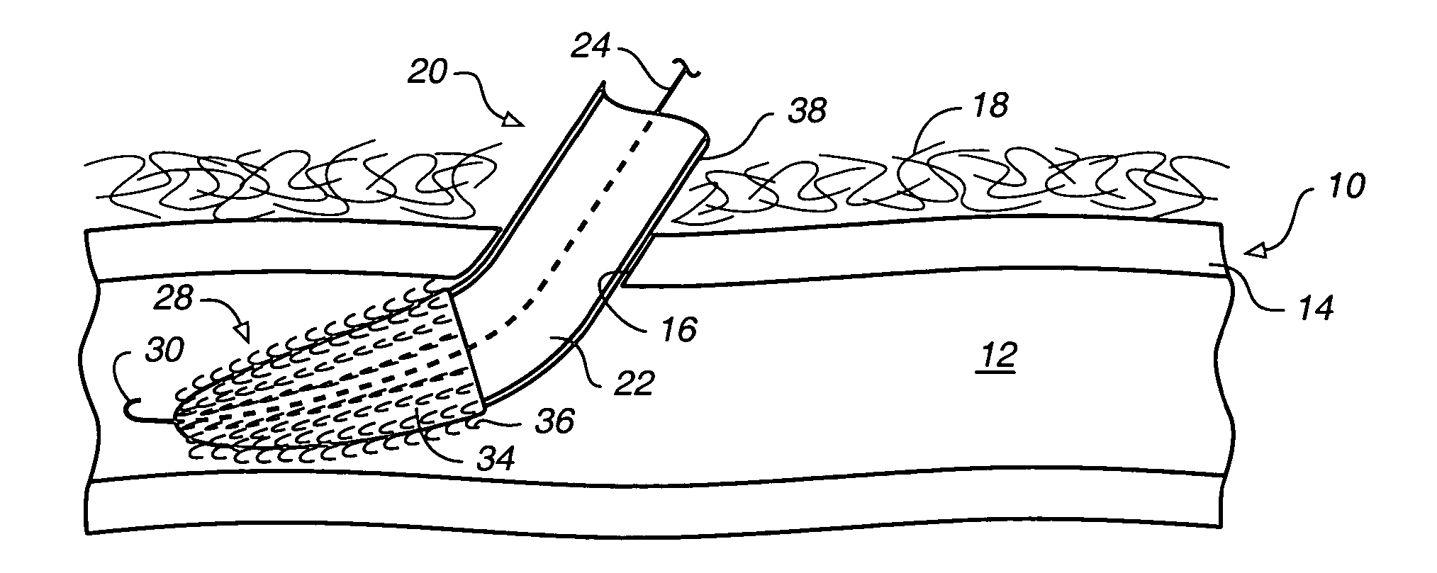 System for closing an opening in a body cavity