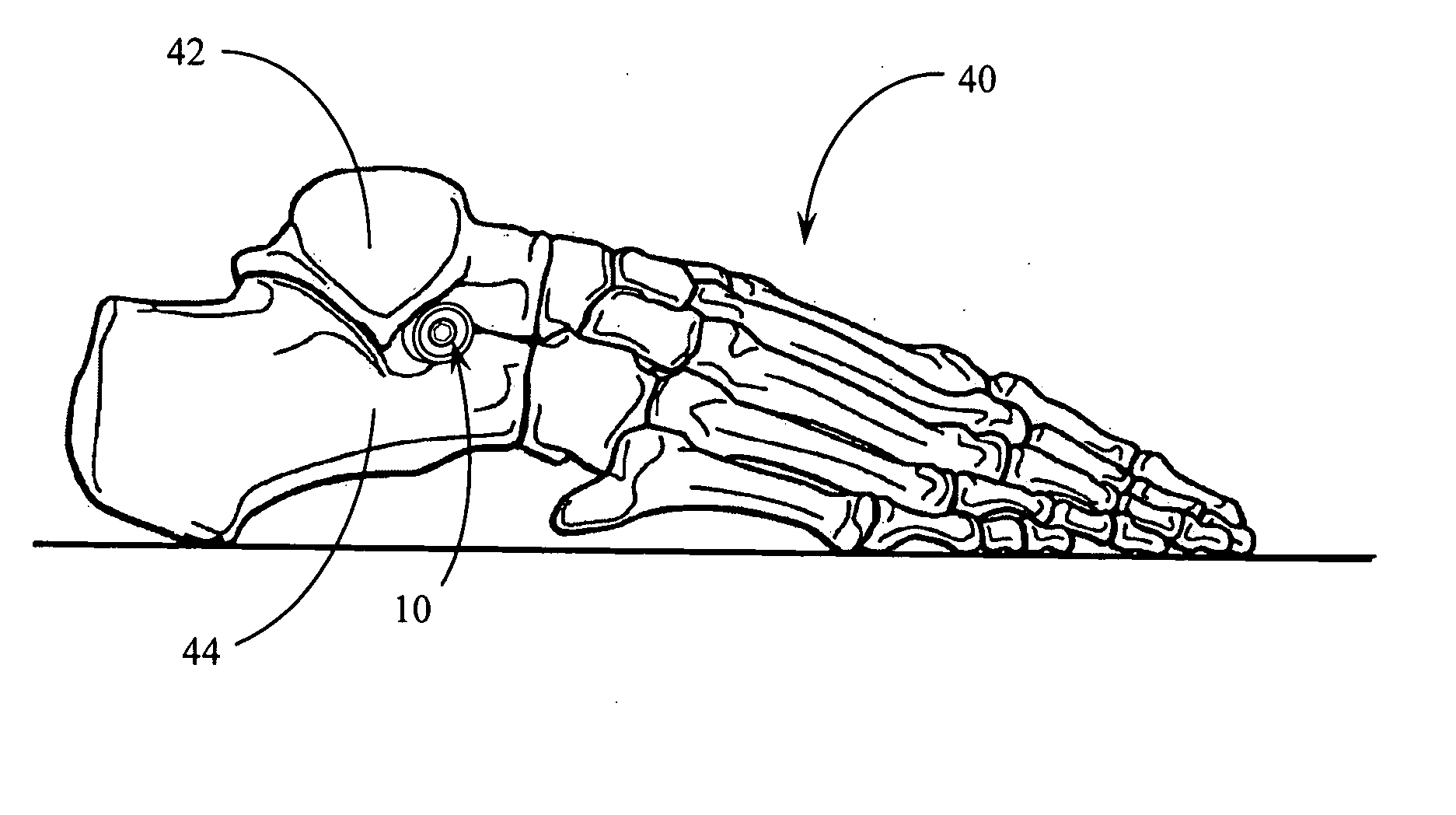 Expandable subtabar implant