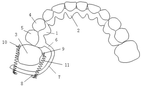 Personalized pulling molars to the distal aligner