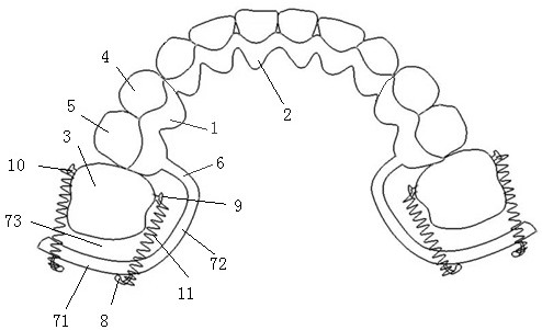 Personalized pulling molars to the distal aligner