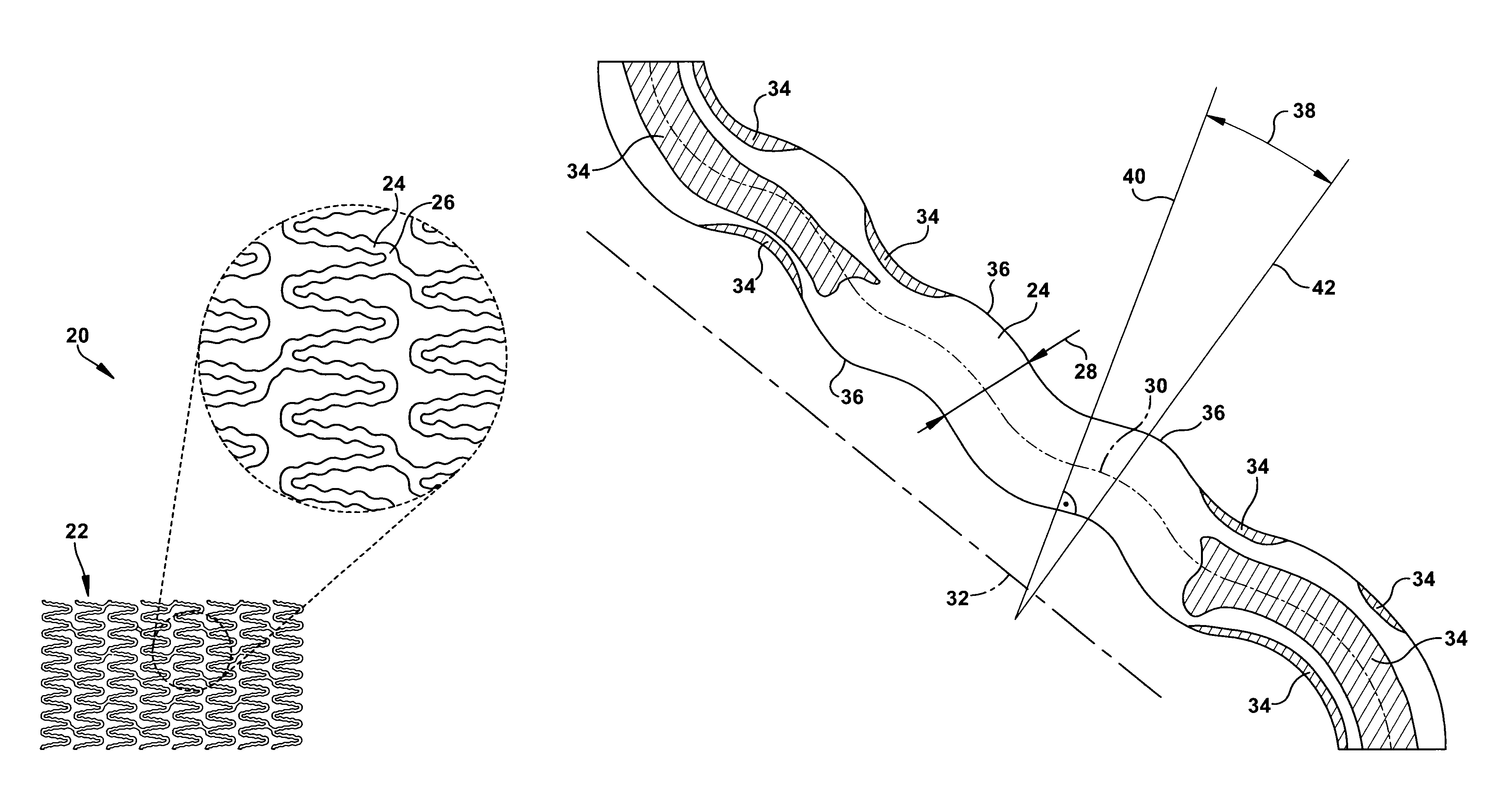 Stent having a bridge structure