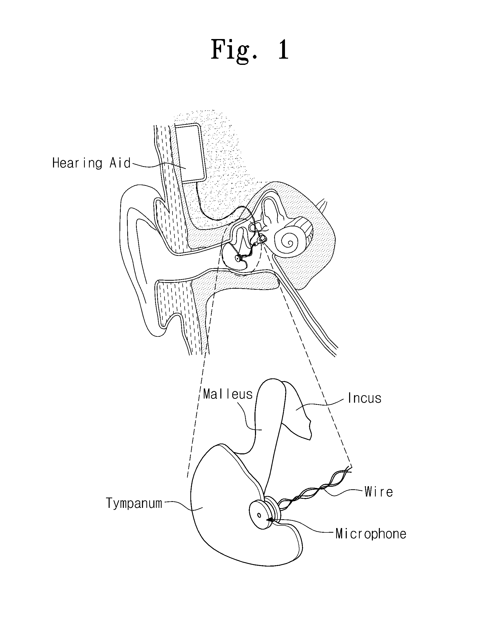 Easily installable microphone for implantable hearing aid