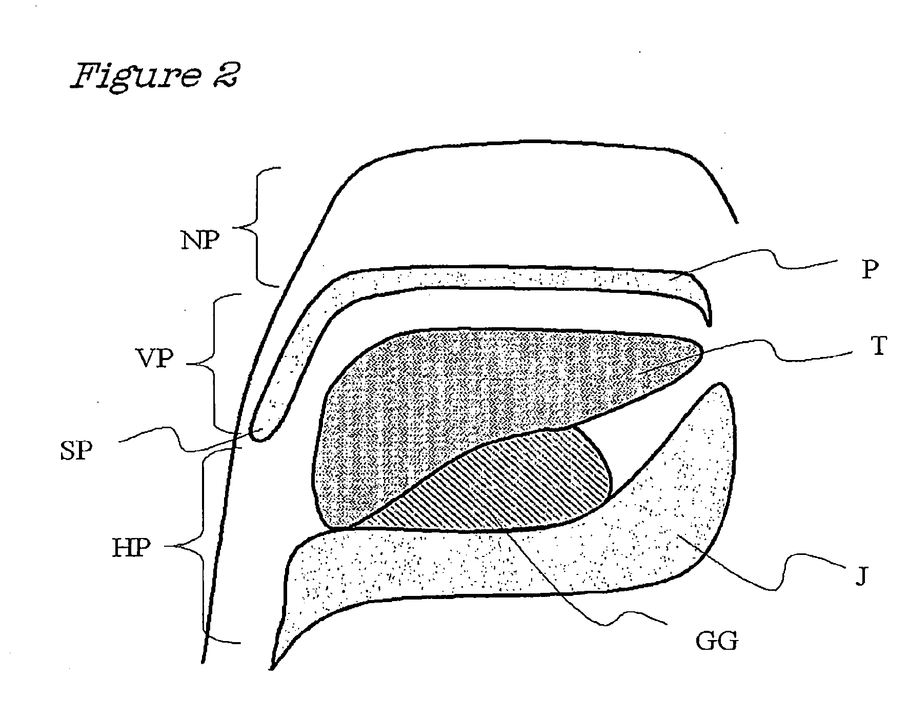 Method and Device for the Treatment of Obstructive Sleep Apnea and Snoring