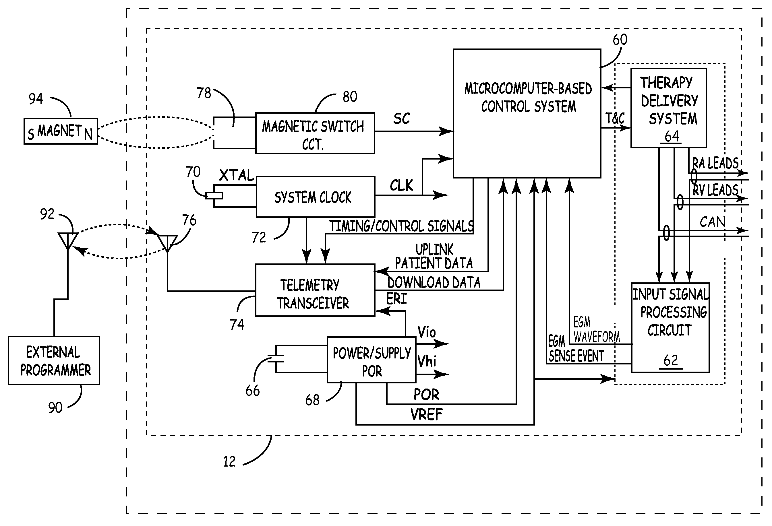 Implantable cardioverter defibrillator with automatically adaptable sensing configuration