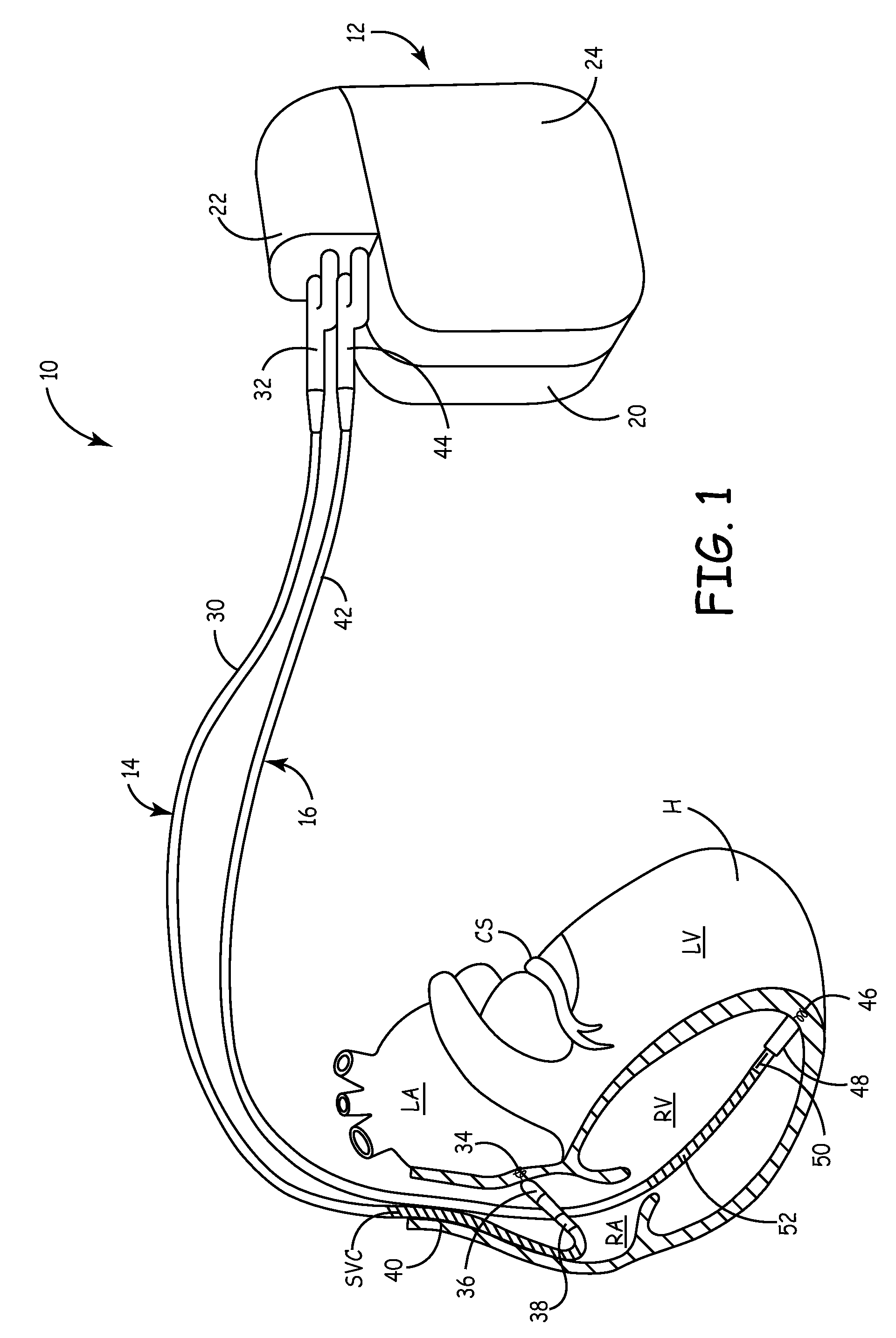 Implantable cardioverter defibrillator with automatically adaptable sensing configuration