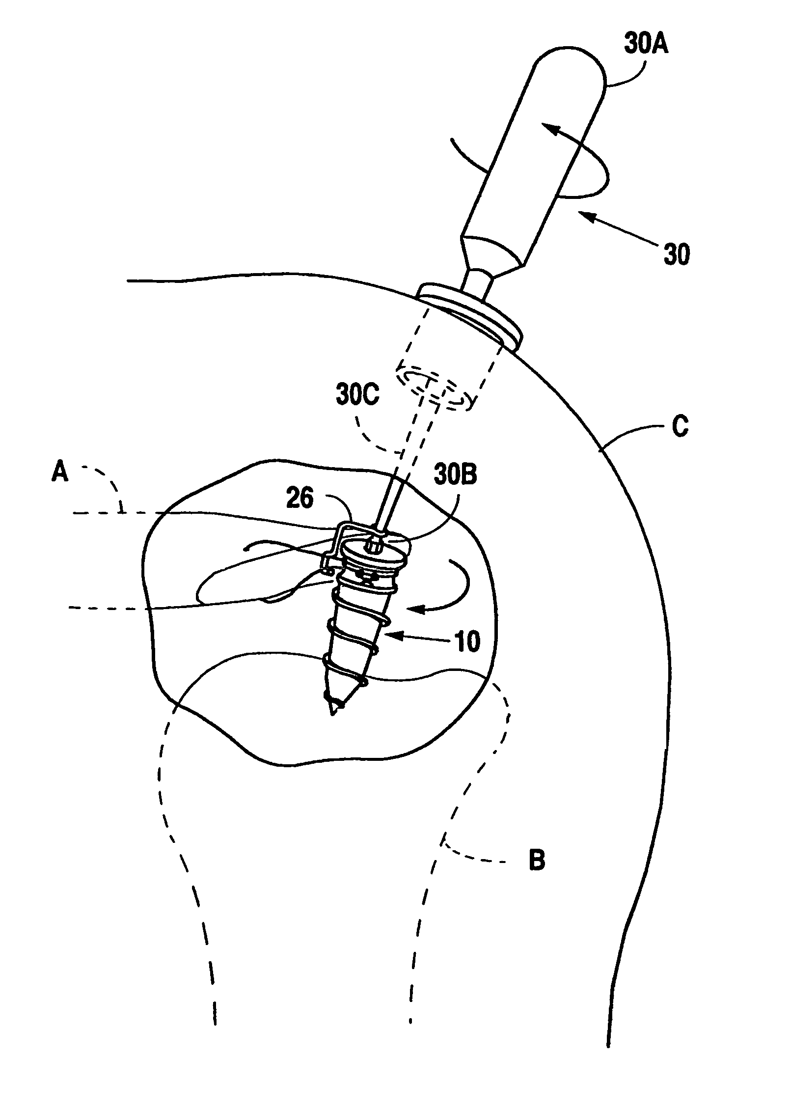 Suture anchor device, kit and method