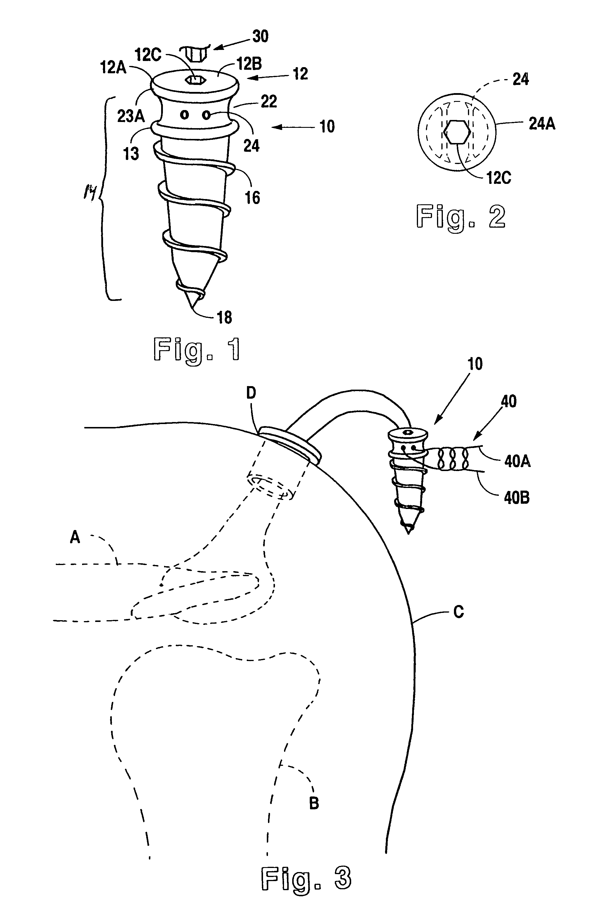 Suture anchor device, kit and method