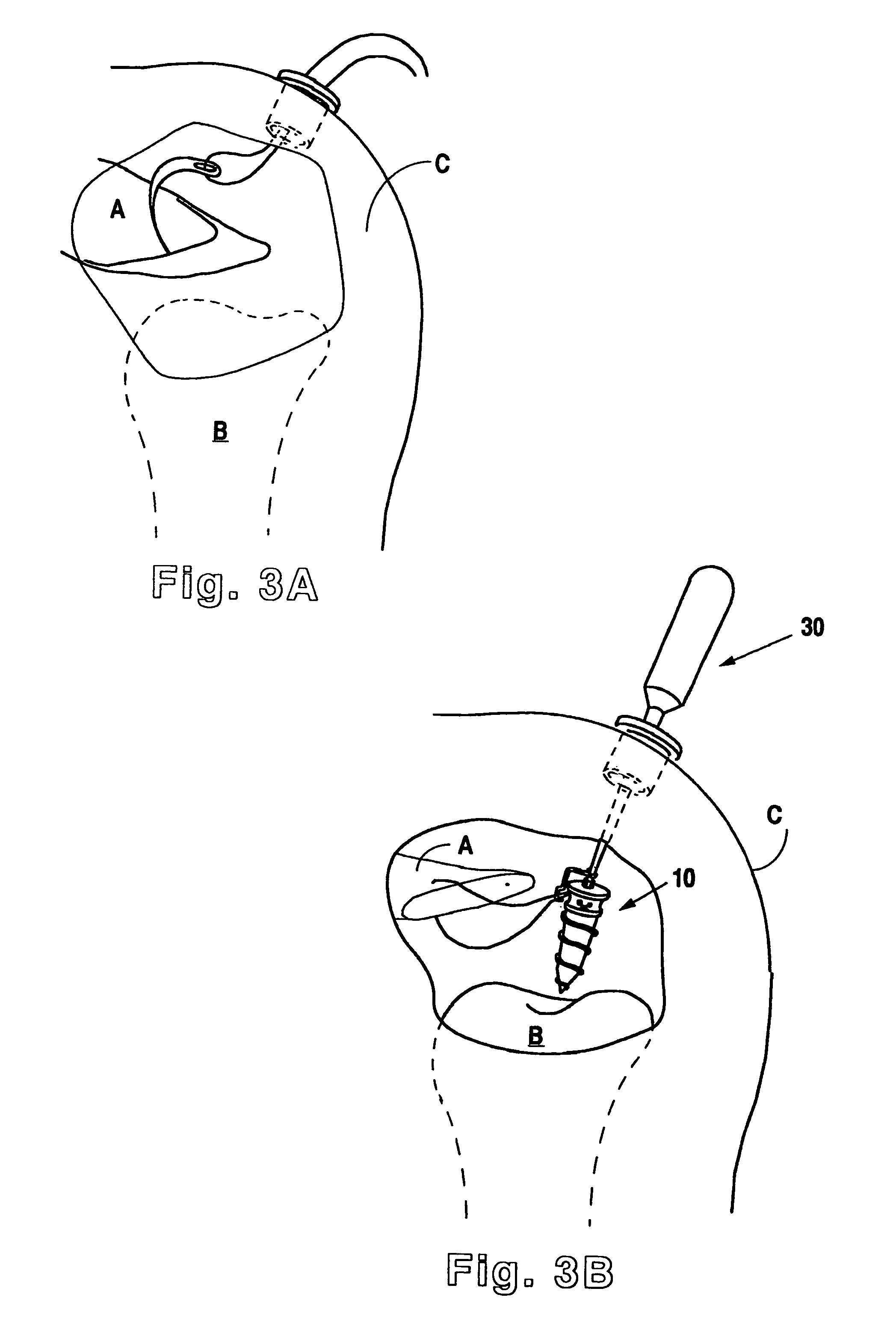 Suture anchor device, kit and method