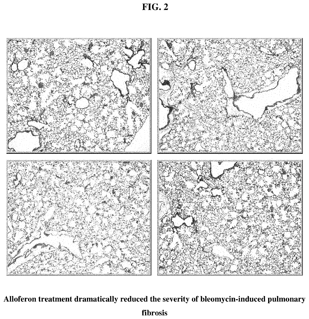 Composition for treating pulmonary fibrosis comprising alloferon