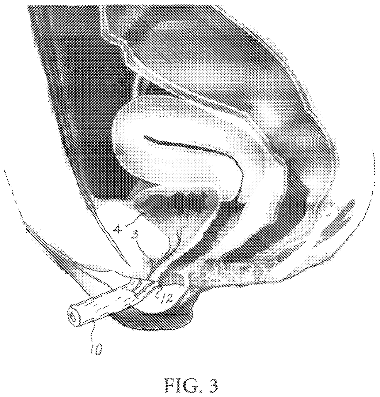 Automated collection and analysis of body fluids