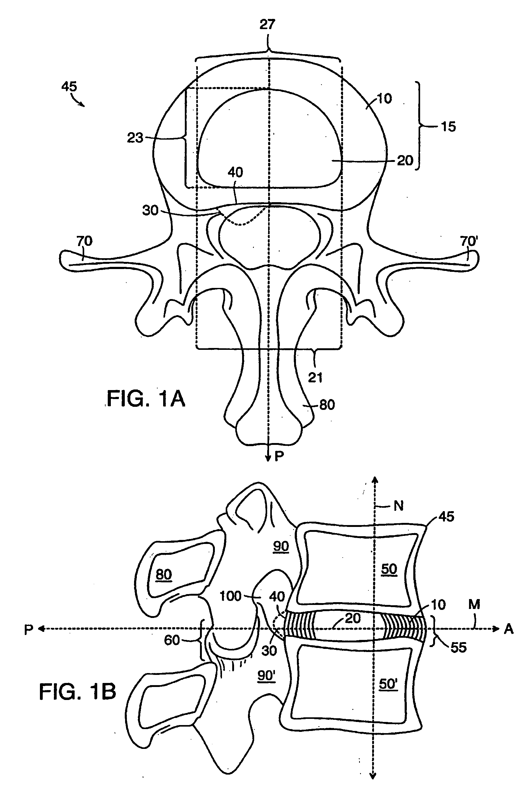 Method of reducing spinal implant migration