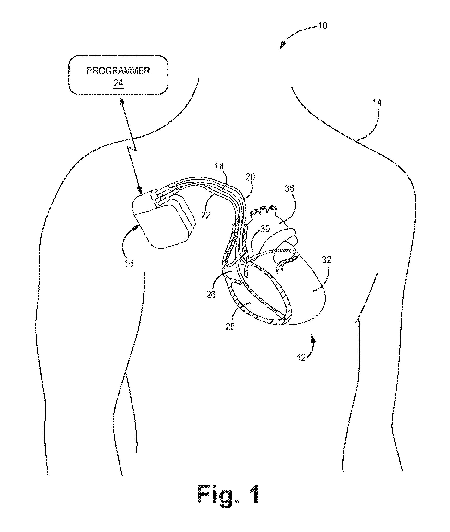 Absolute intrathoracic impedance based scheme to stratify patients for risk of a heart failure event