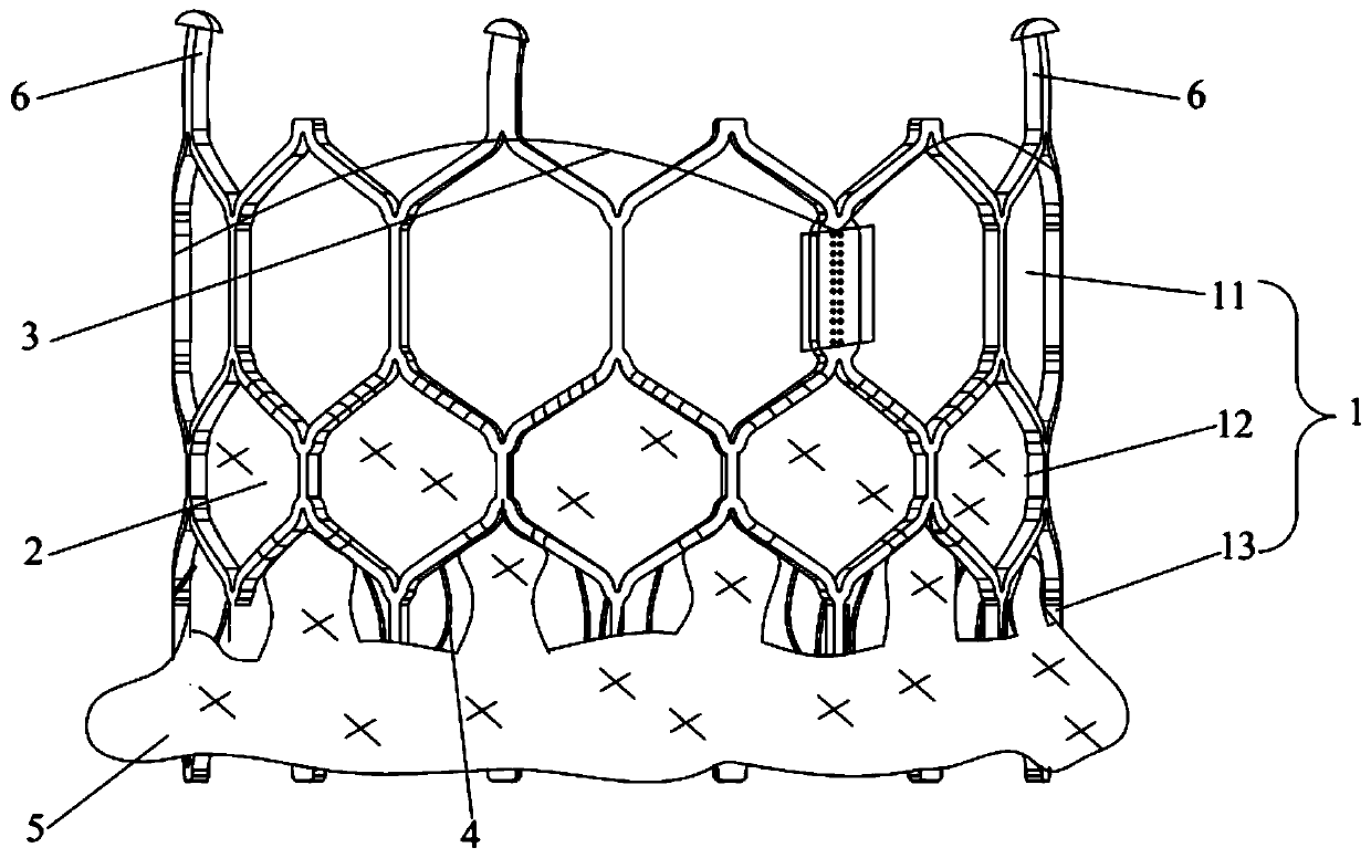 Transcatheter interventional artificial valve