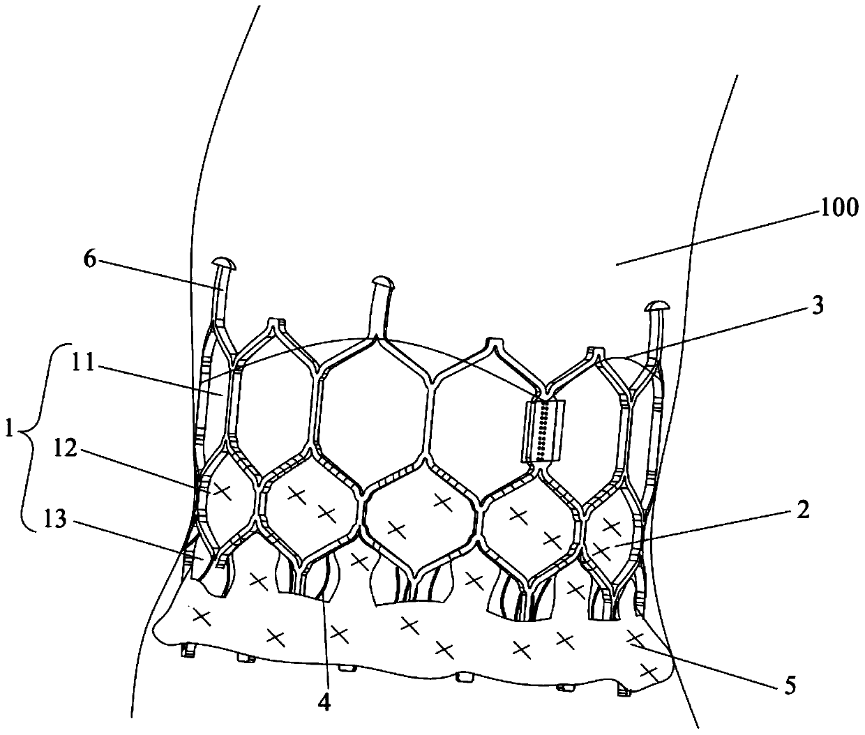 Transcatheter interventional artificial valve