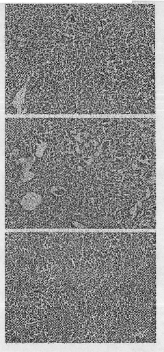 Genomic medicine for inhabiting lung cancer transfer and pulmonary metastatic tumor