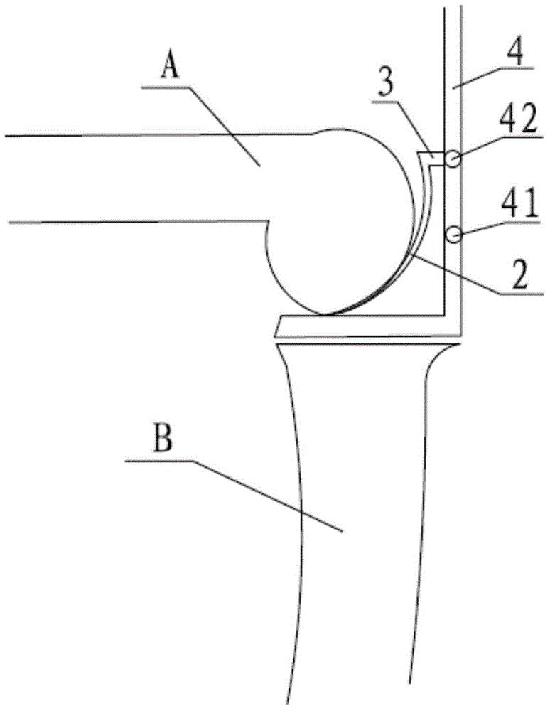 Femoral condyle gauge for unicompartmental arthroplasty