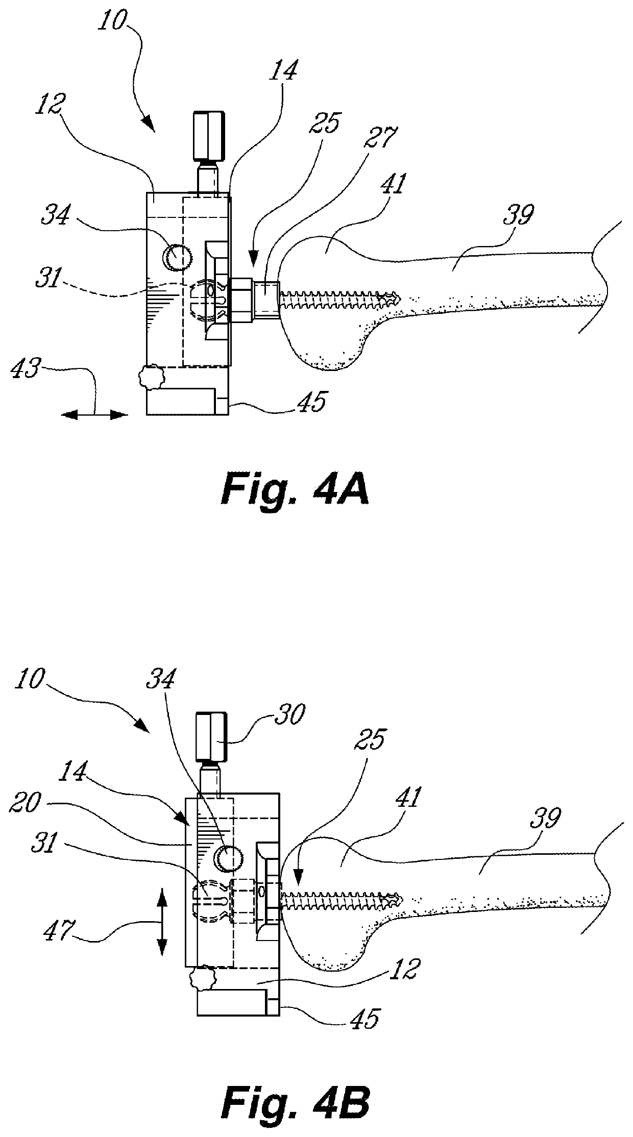 Method and system for planning/guiding alterations to a bone