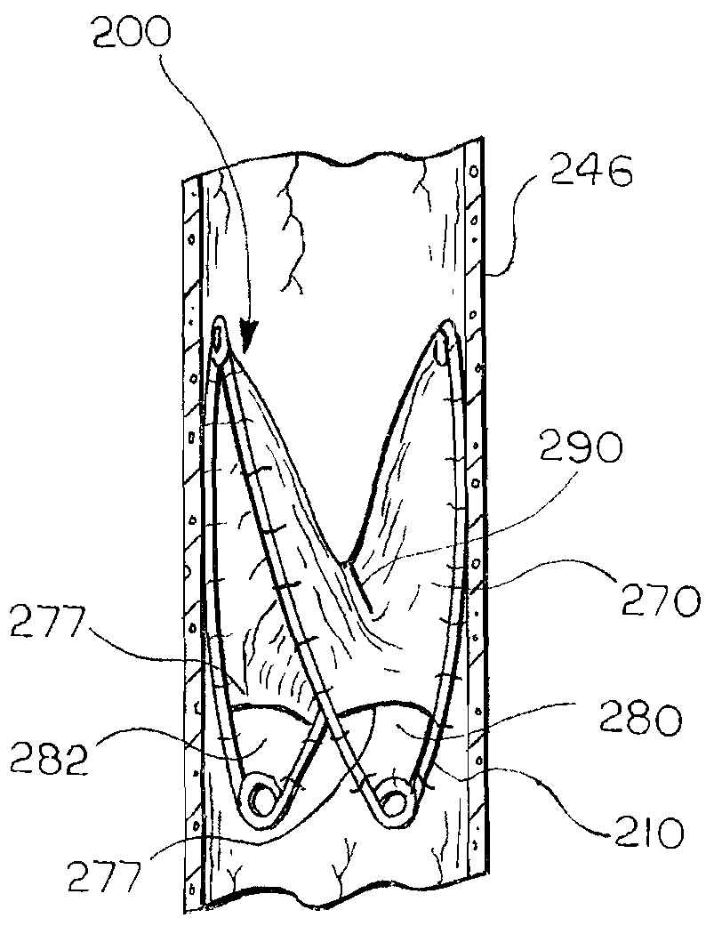 Prosthetic valve that permits retrograde flow