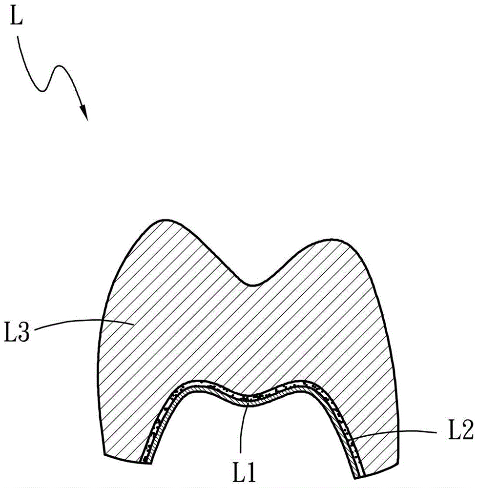 Technology and structure of fused light composite epoxy resin on the surface of inner crown