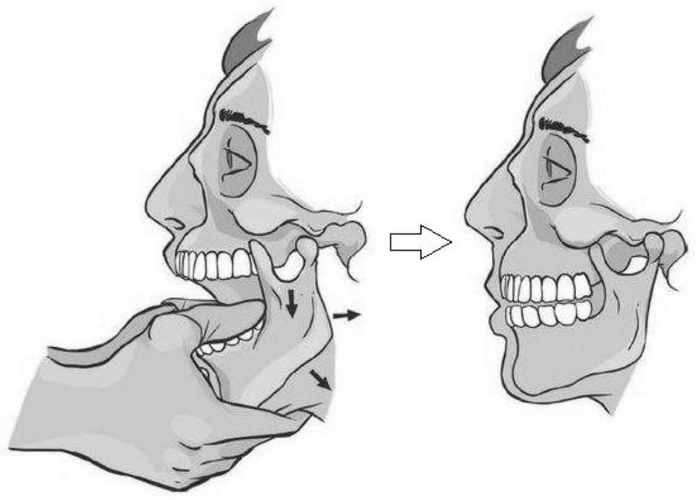 Fingerstall for temporomandibular joint reduction