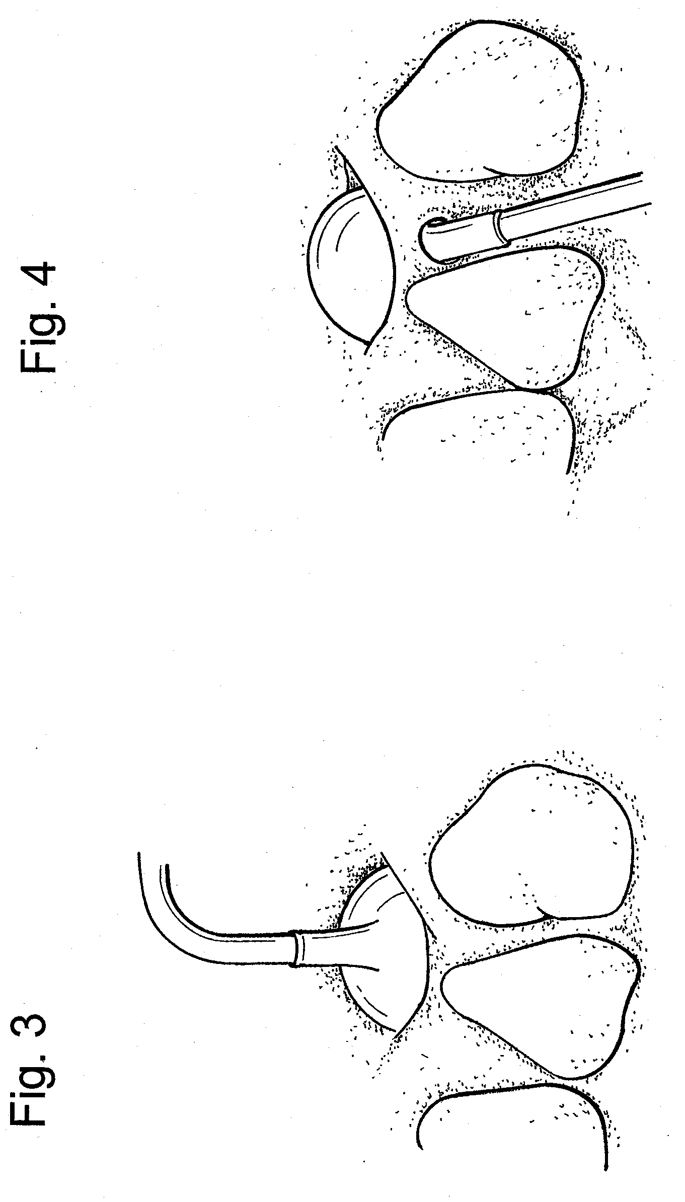 Collagen Antral Membrane Expander