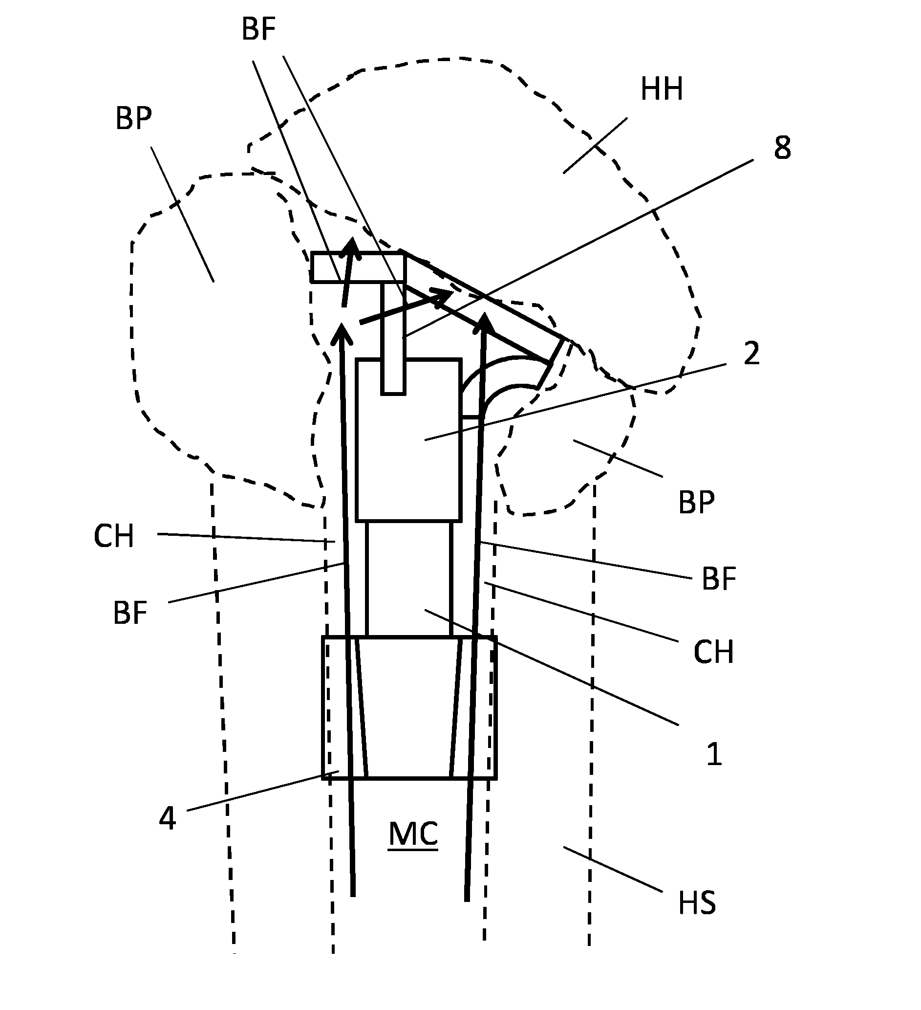 A medical device for reconstruction of a humerus for the operative treatment of a proximal humerus fracture