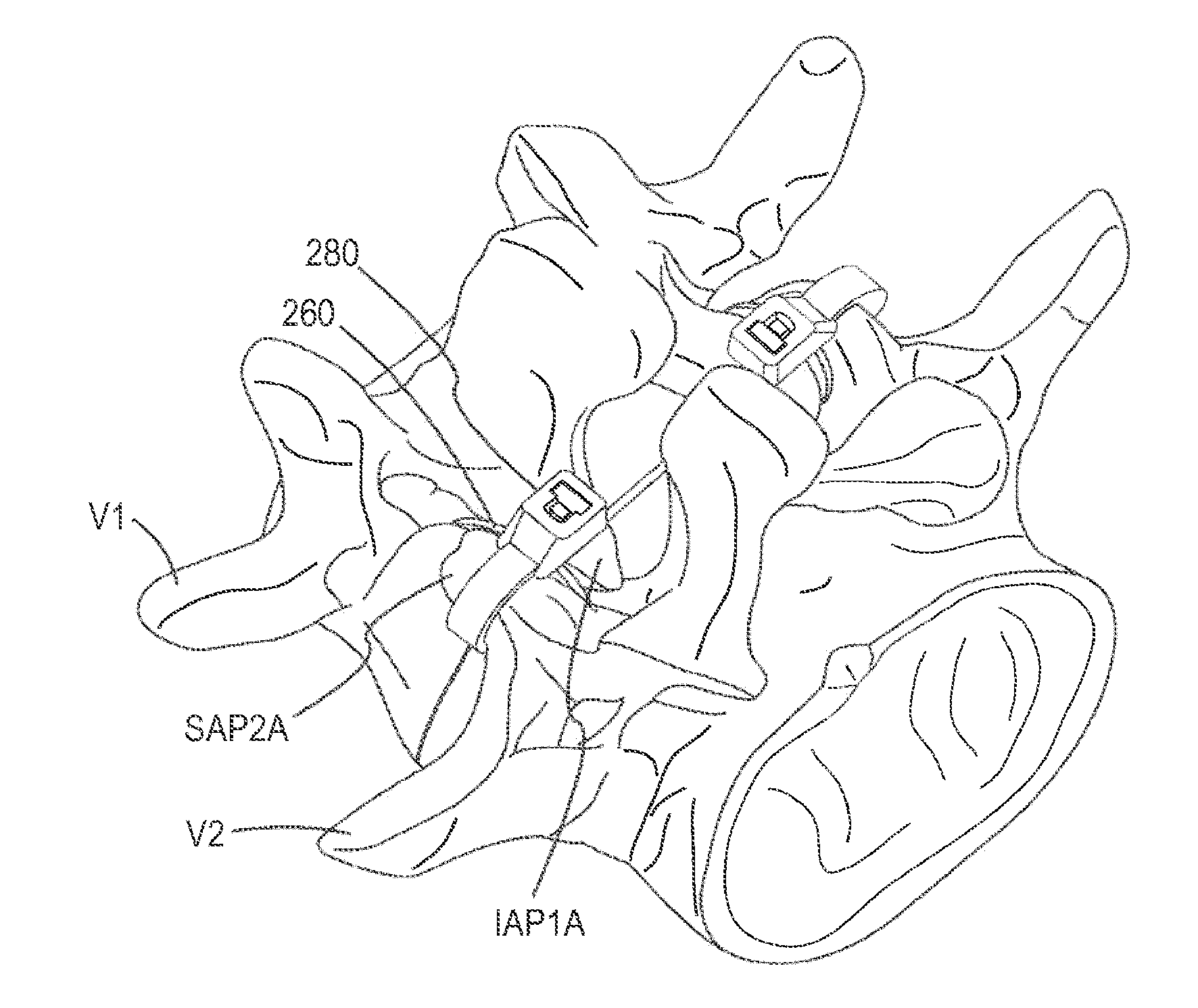 Device and method for reinforcement of a facet