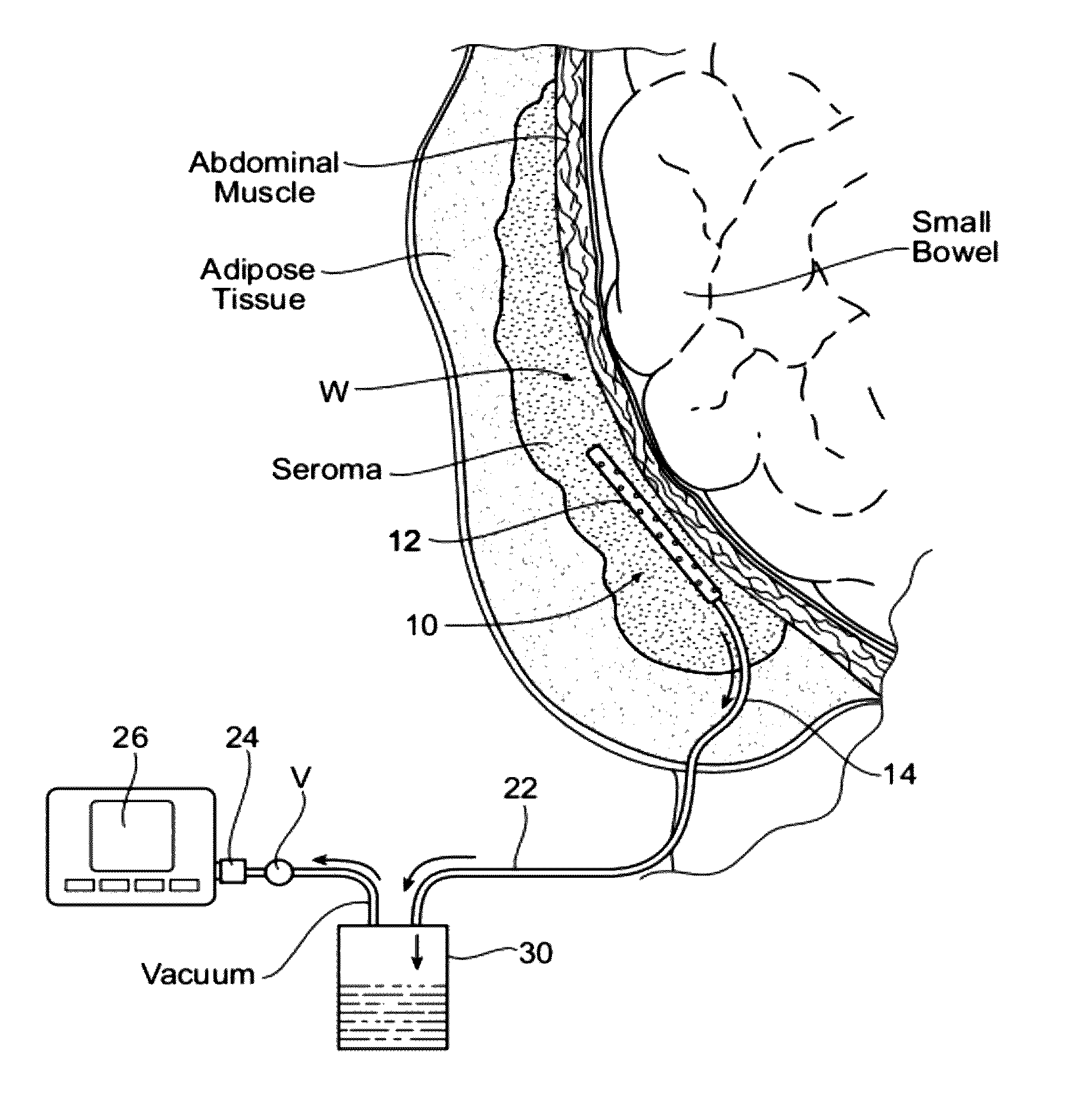 Assemblies, systems, and methods for vacuum assisted internal drainage during wound healing