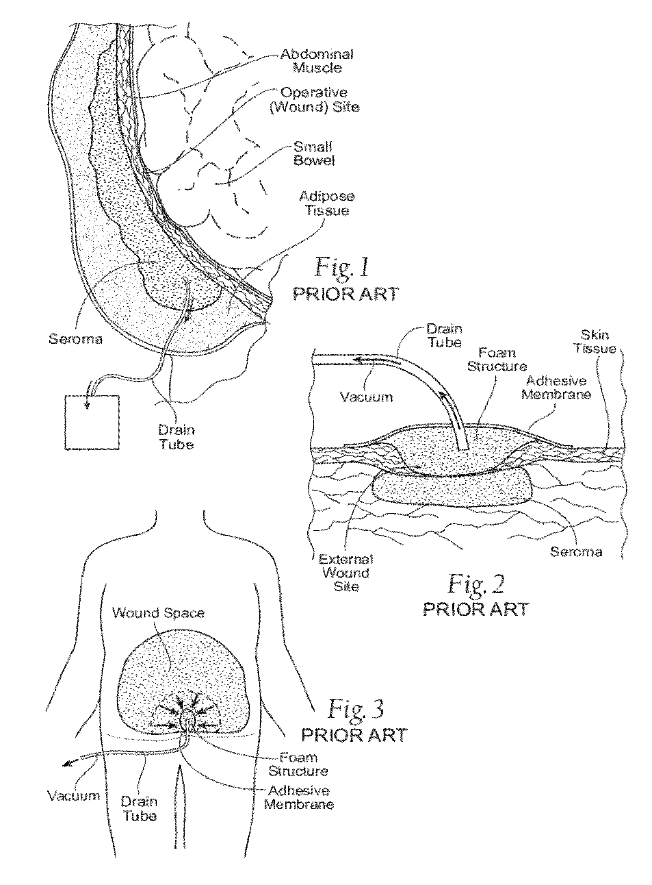 Assemblies, systems, and methods for vacuum assisted internal drainage during wound healing