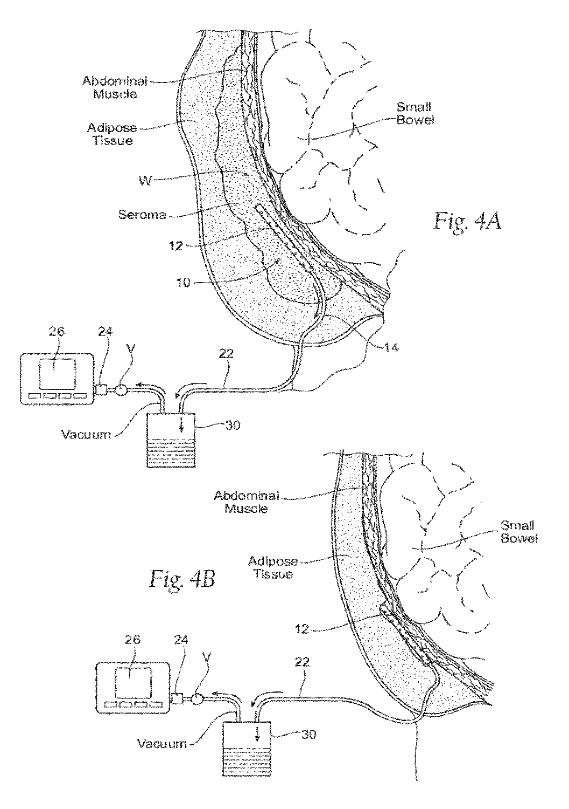 Assemblies, systems, and methods for vacuum assisted internal drainage during wound healing