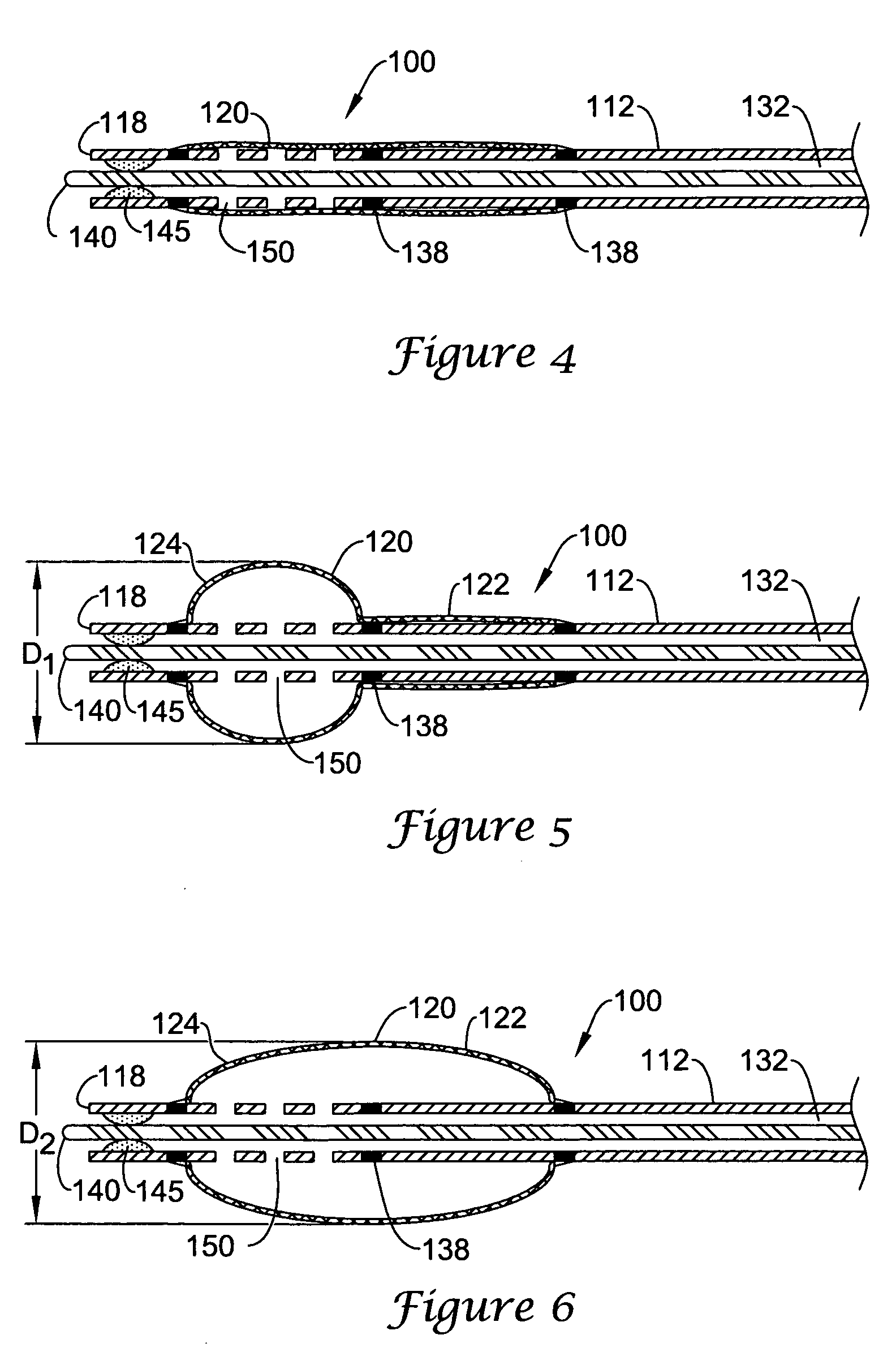 Occlusion balloon catheter with longitudinally expandable balloon