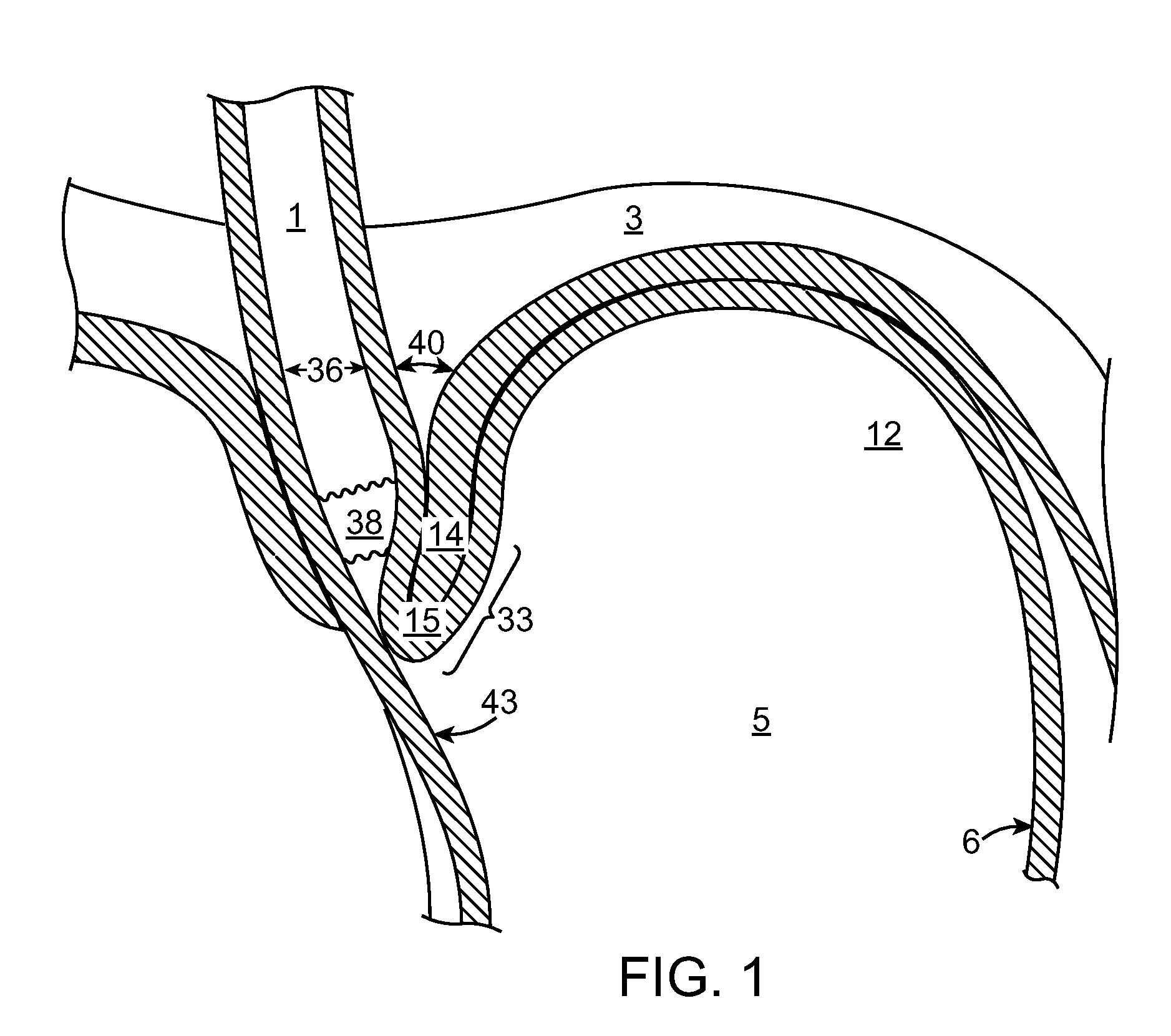 Methods and systems for treating hiatal hernias