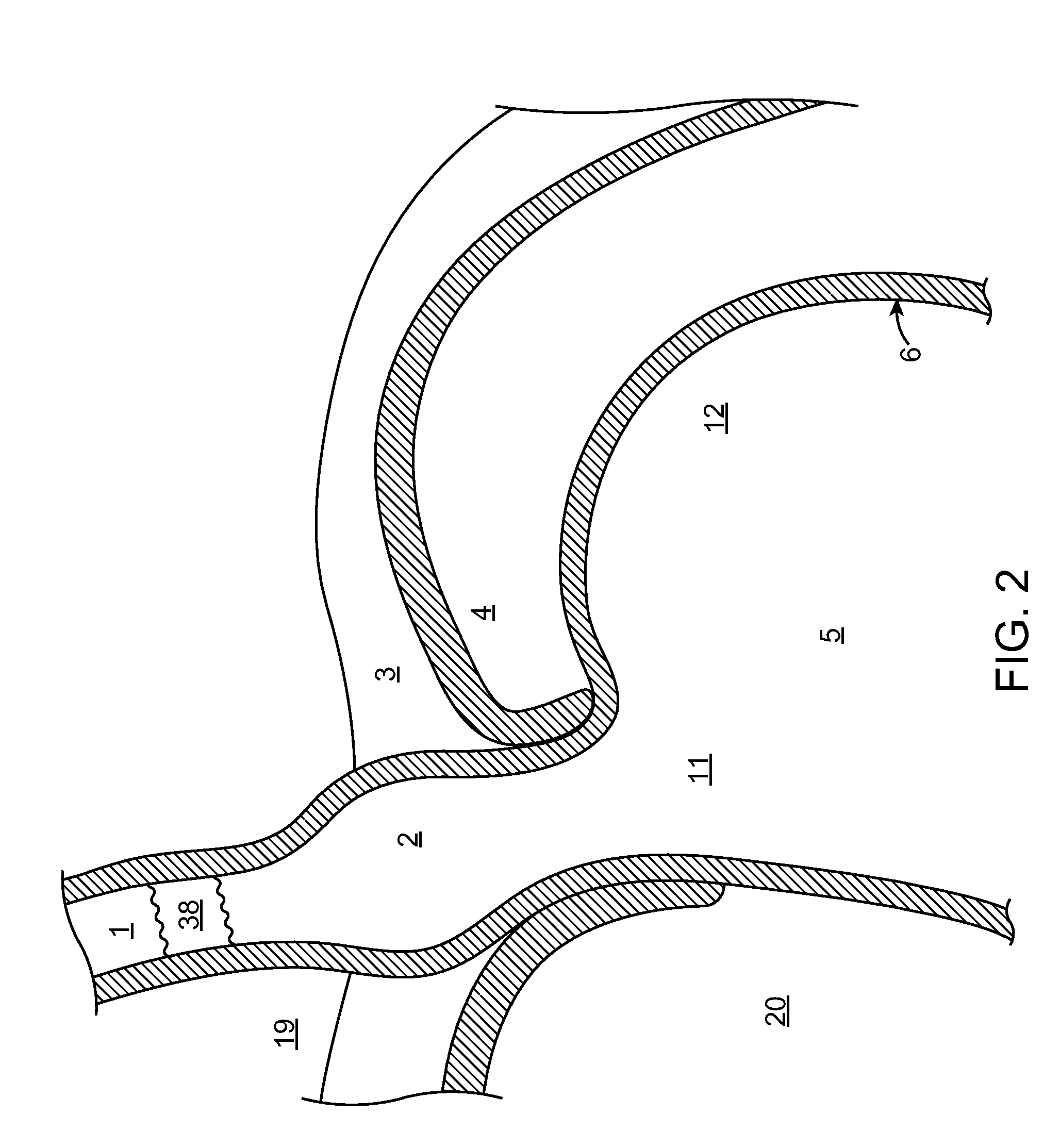 Methods and systems for treating hiatal hernias