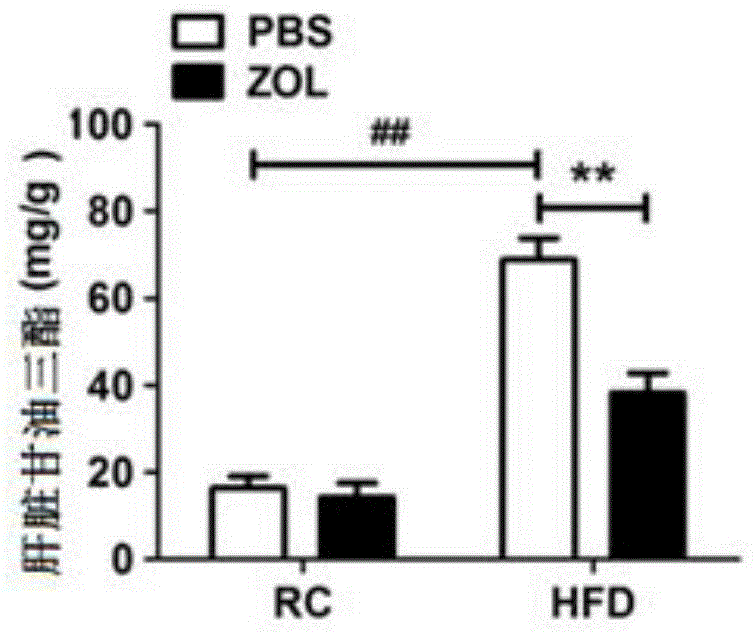 Application of zoledronic acid in preparation of drugs for treating fatty liver diseases