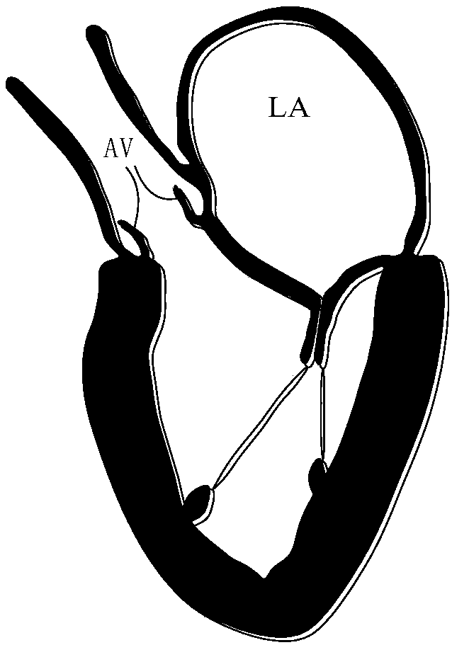 Artificial chordae implantation system provided with detection device