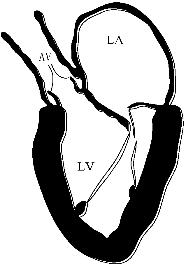 Artificial chordae implantation system provided with detection device