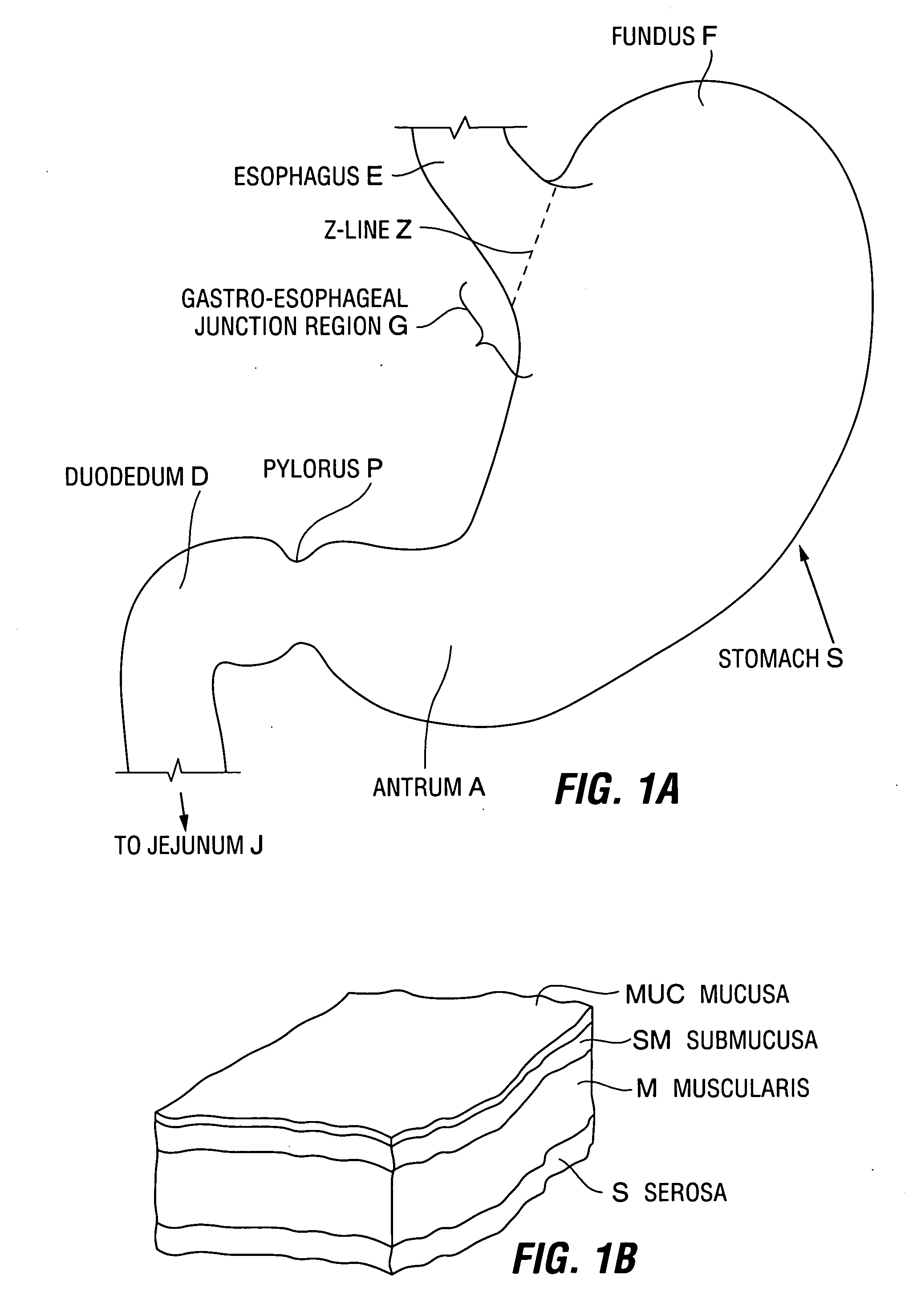 Restrictive and/or obstructive implant system for inducing weight loss