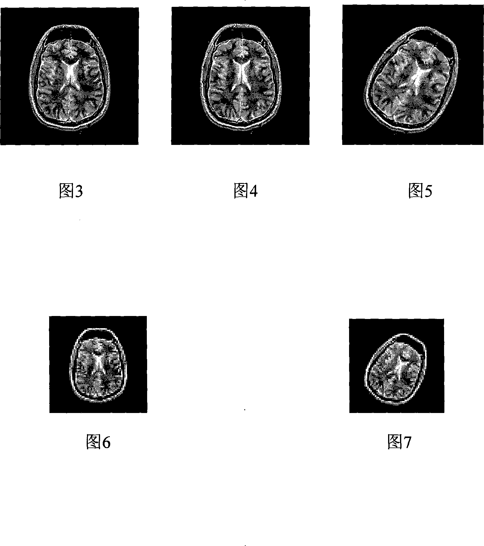 A multi-resolution medical image registration method based on quantum behaviors particle swarm algorithm