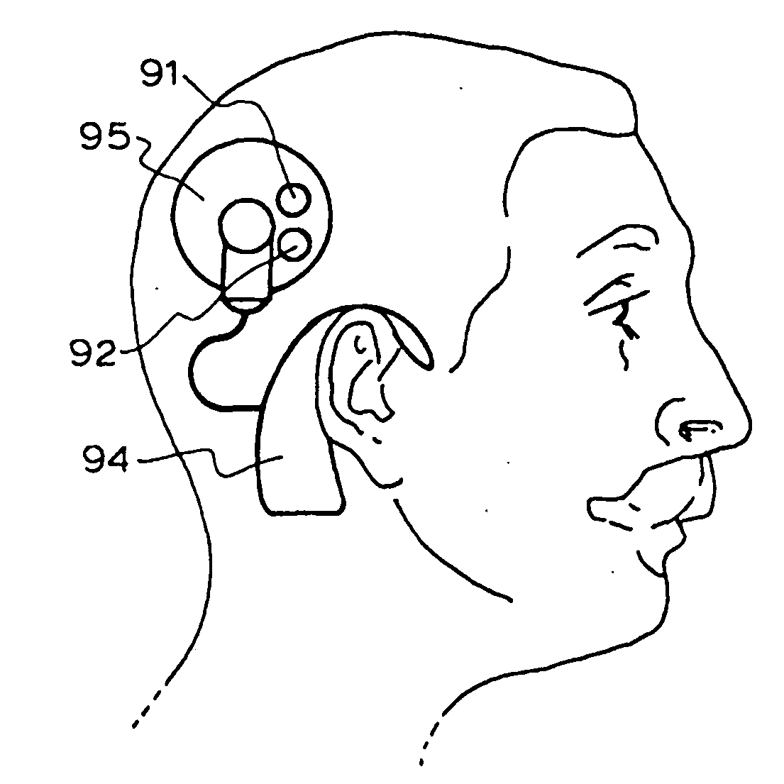 Implantable Microphone System and Calibration Process