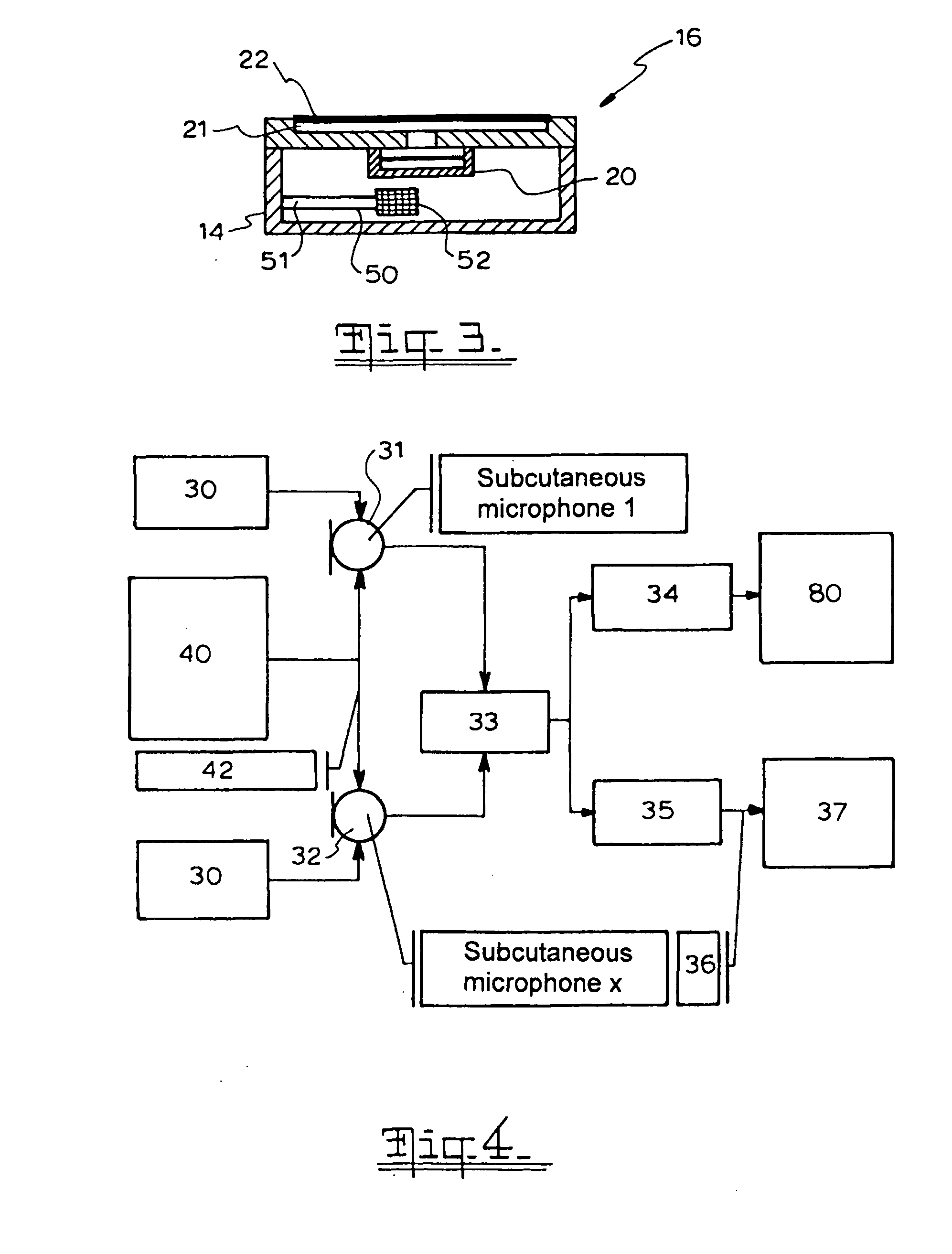 Implantable Microphone System and Calibration Process