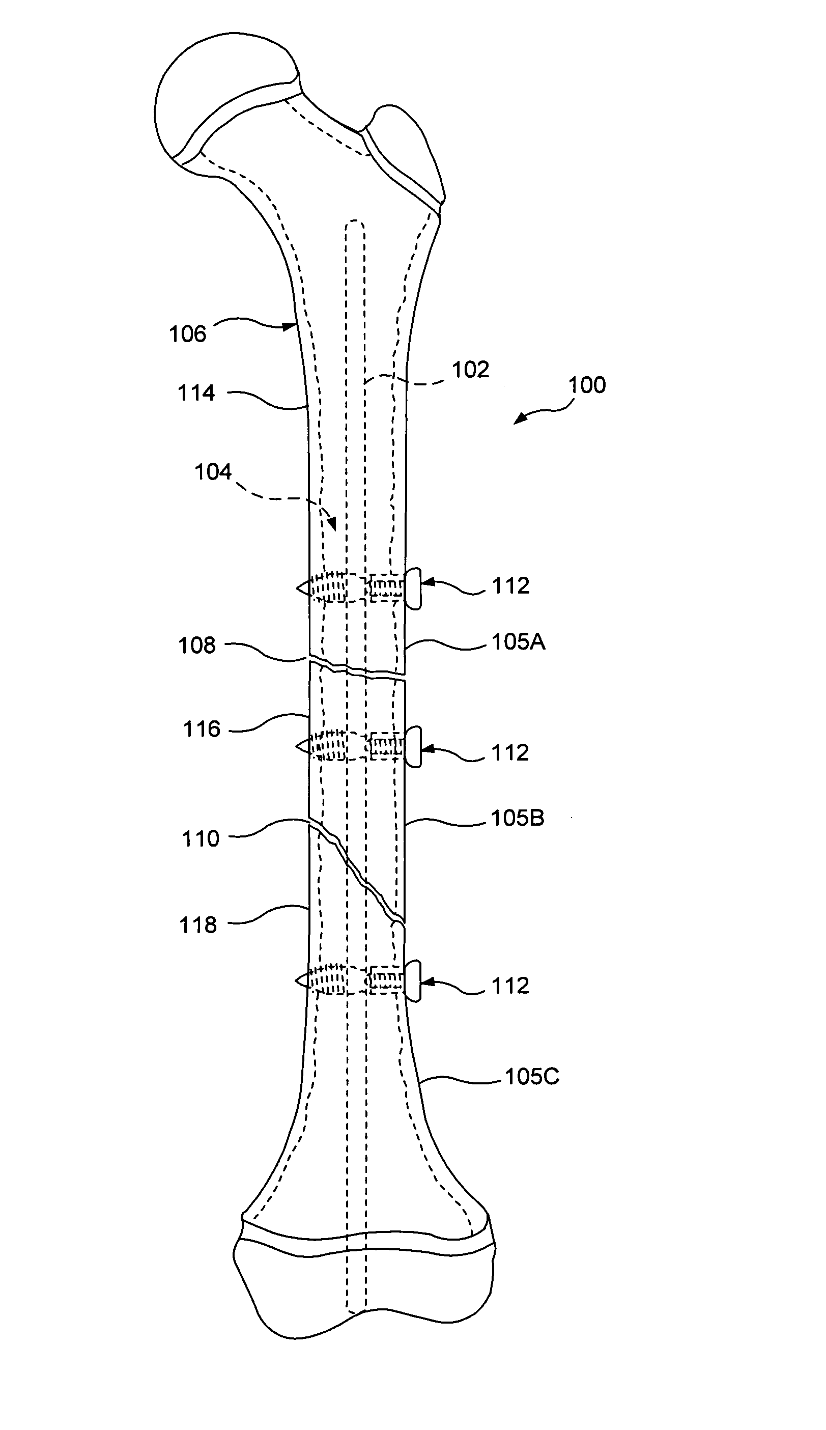 System for intramedullary rod fixation and method therefor