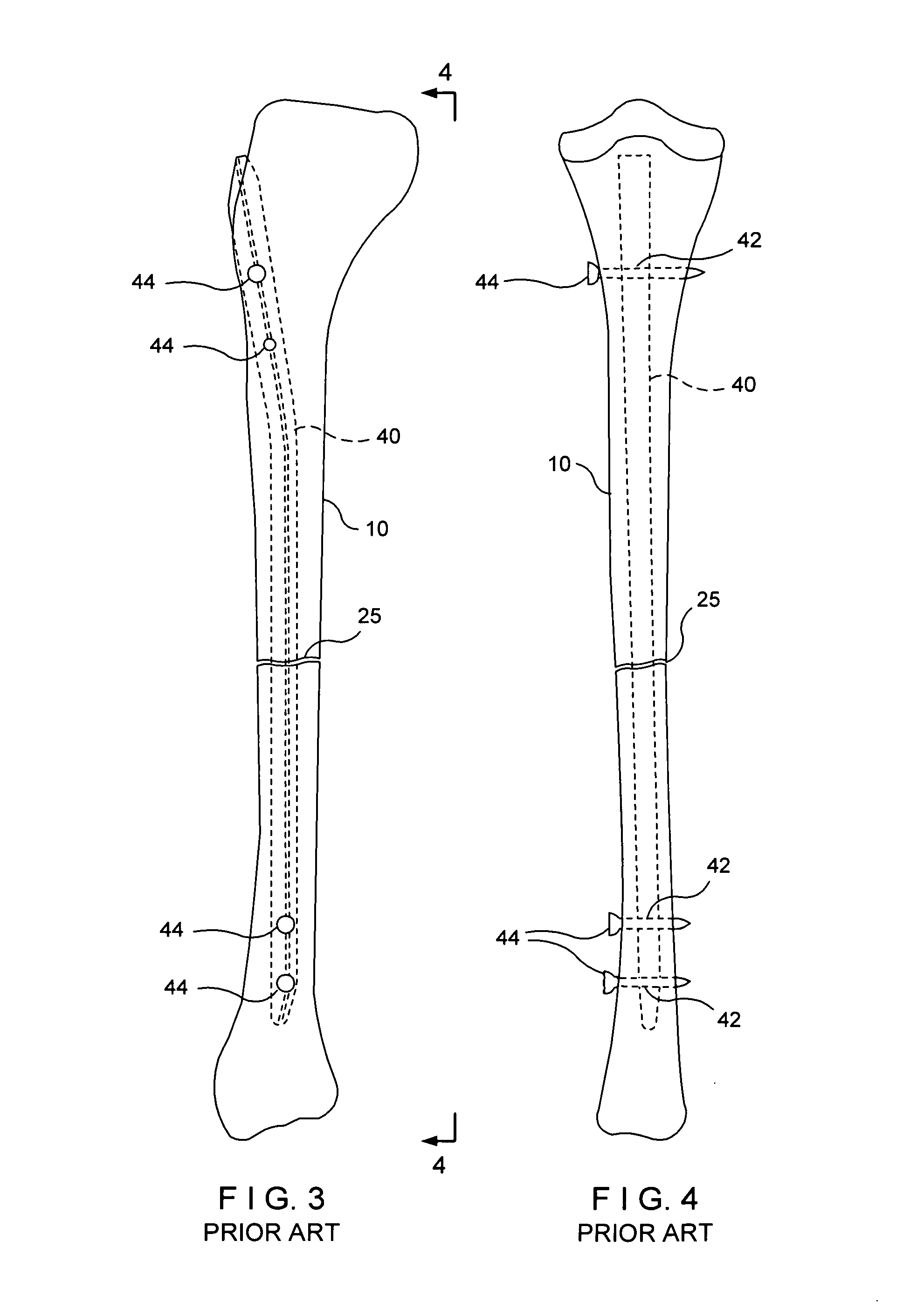 System for intramedullary rod fixation and method therefor