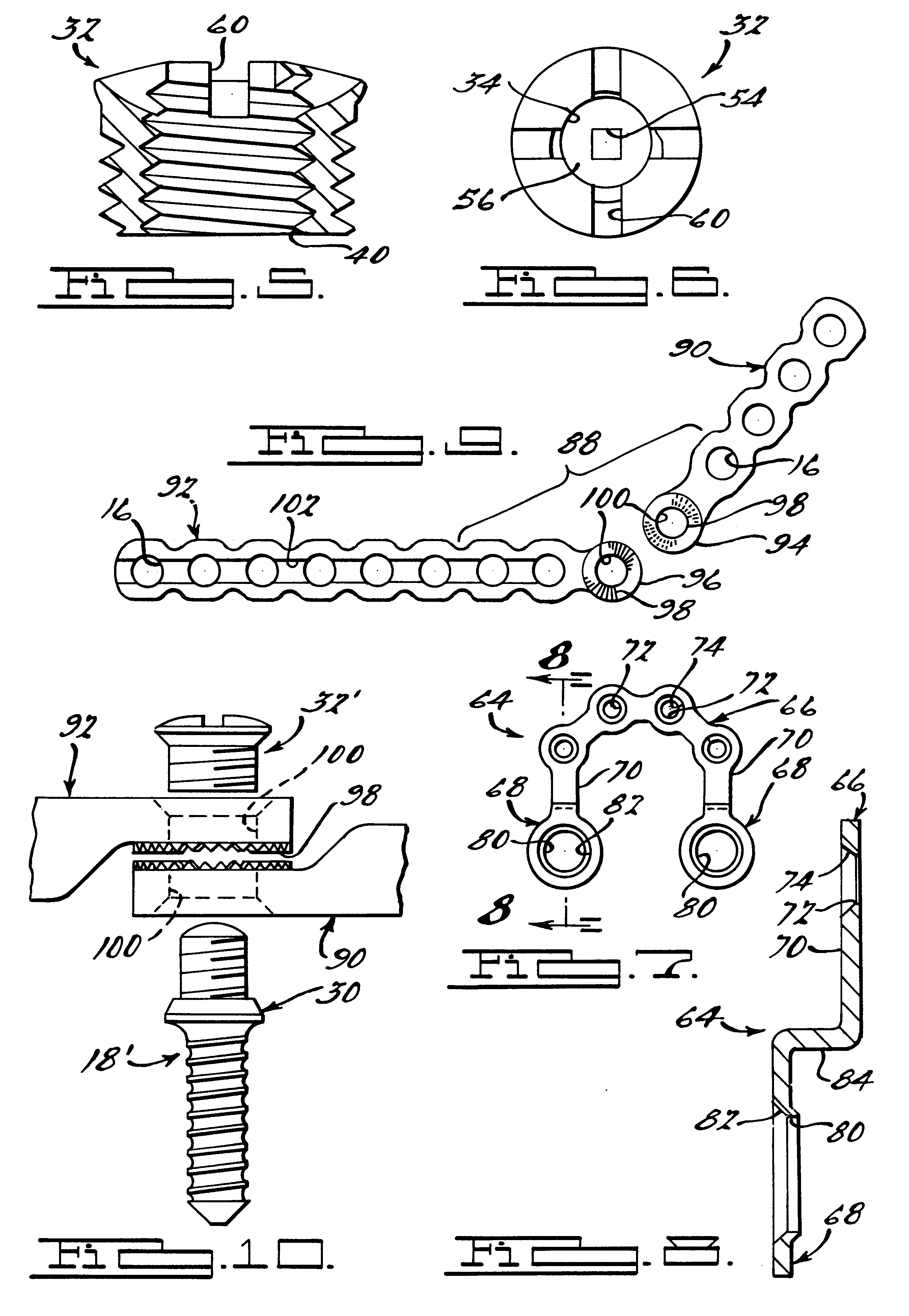 Method and apparatus for mandibular osteosynthesis