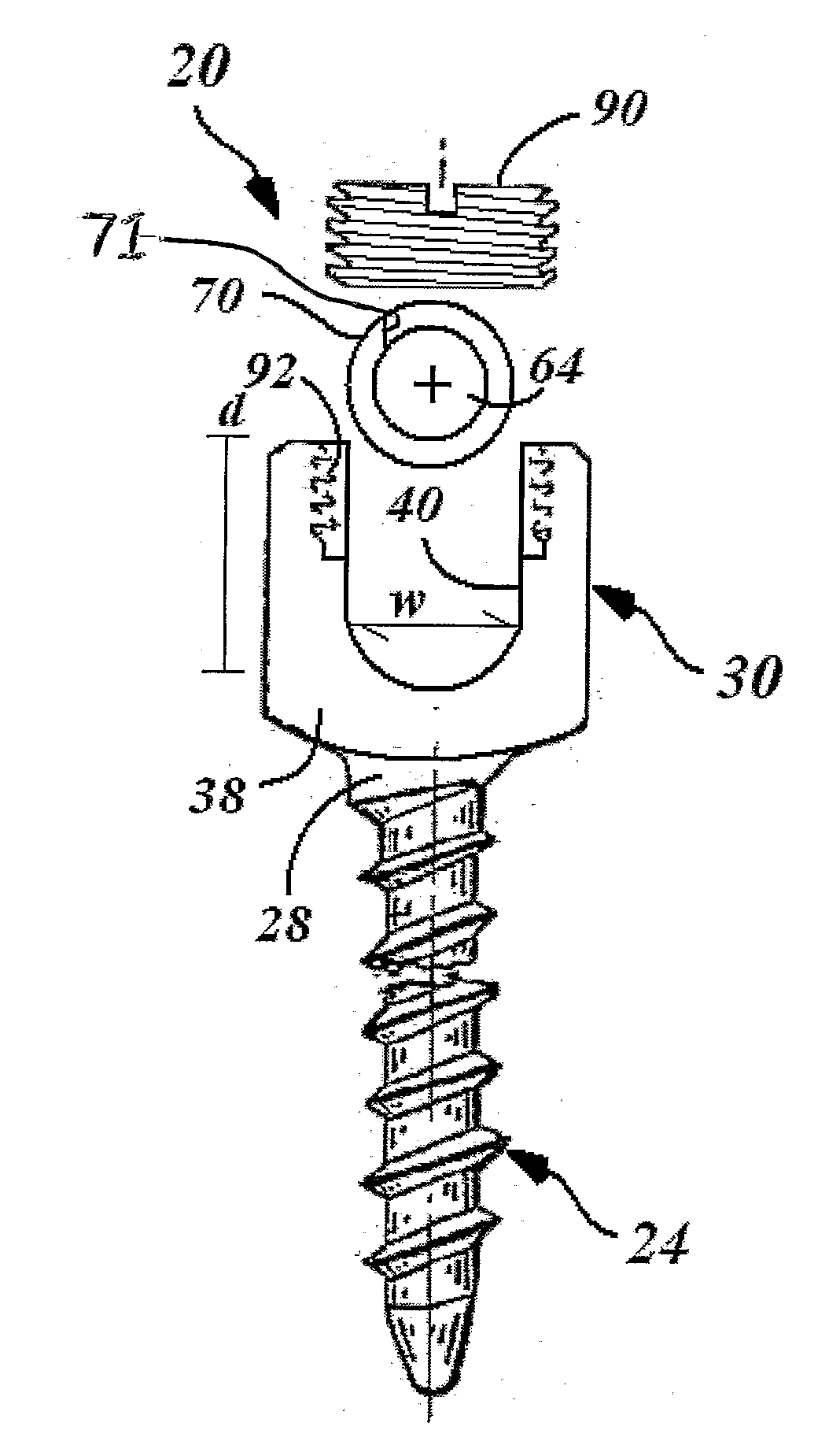 Dynamic intervertebral stabilization system