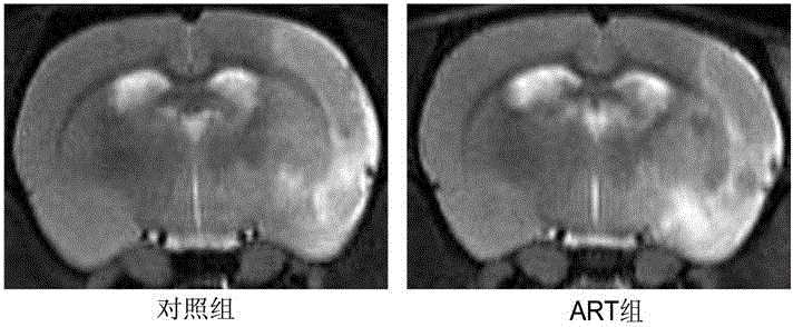 Application of artesunate in preparing medicine for treating and preventing central nerve injury