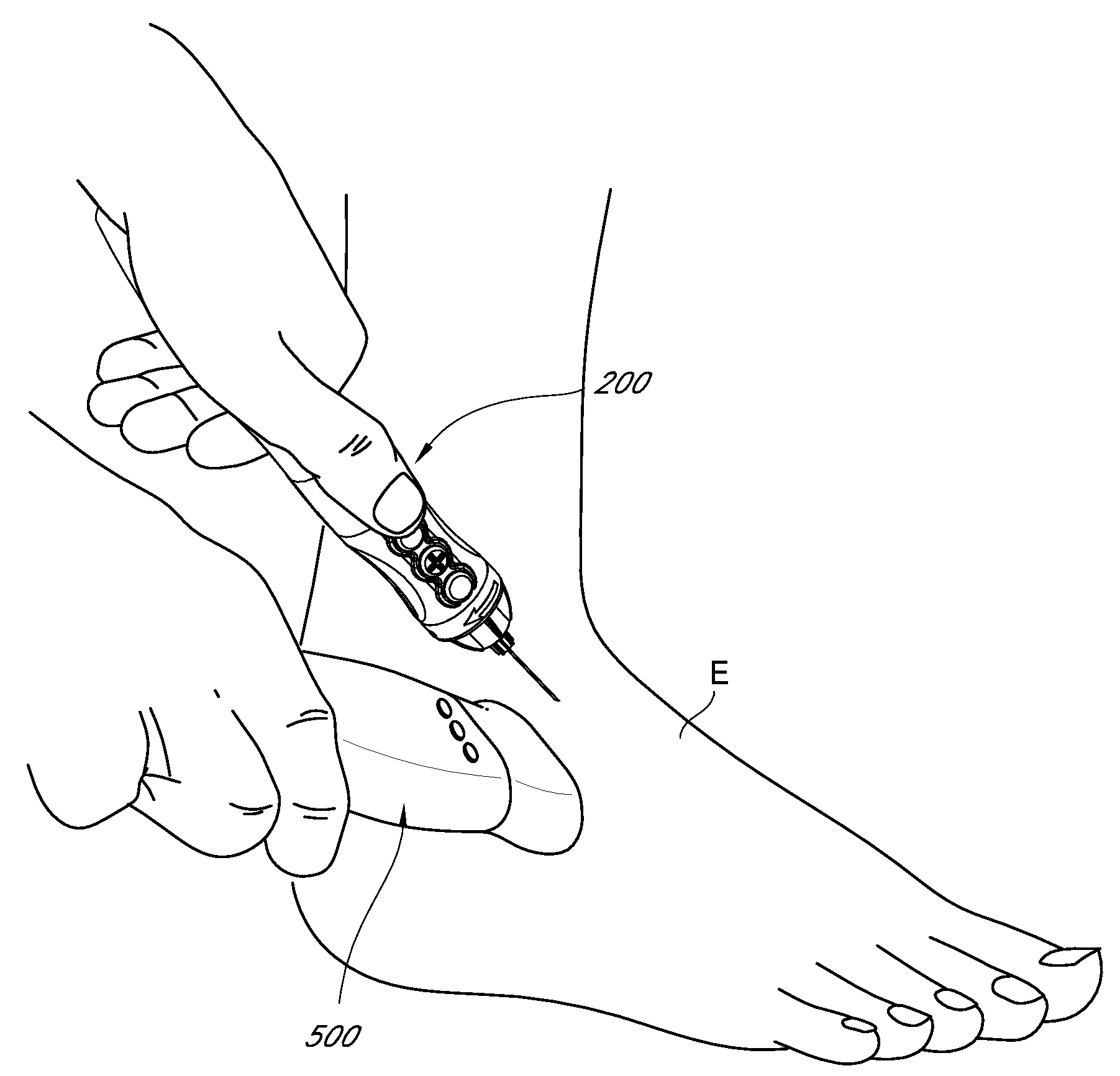 Articular injection system