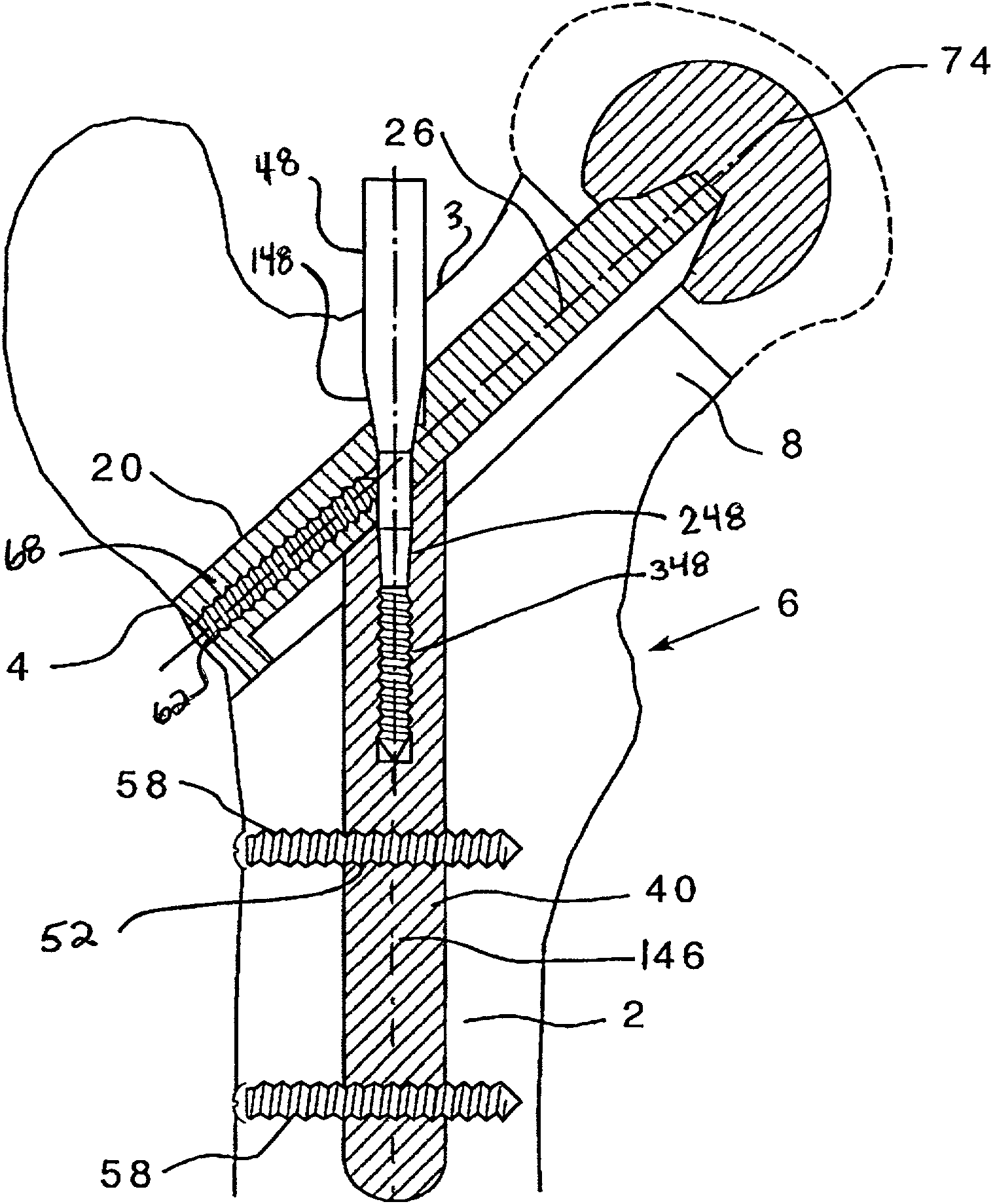 Modular hip implants