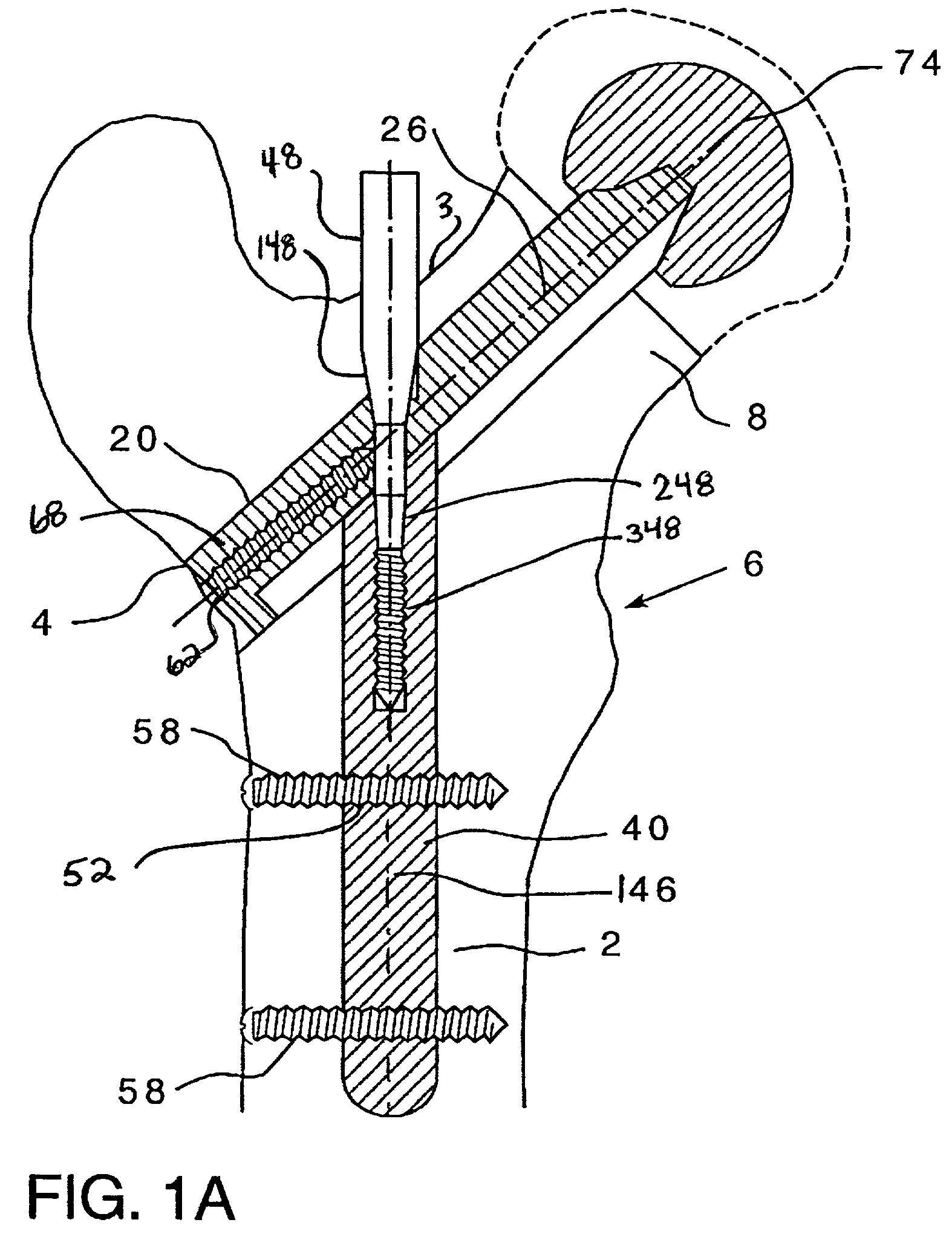 Modular hip implants