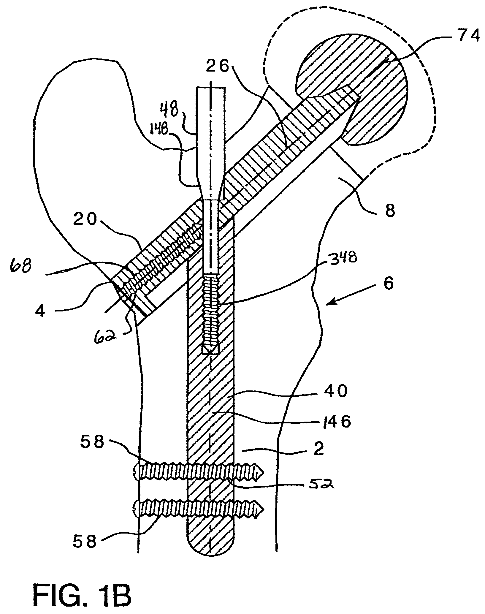 Modular hip implants