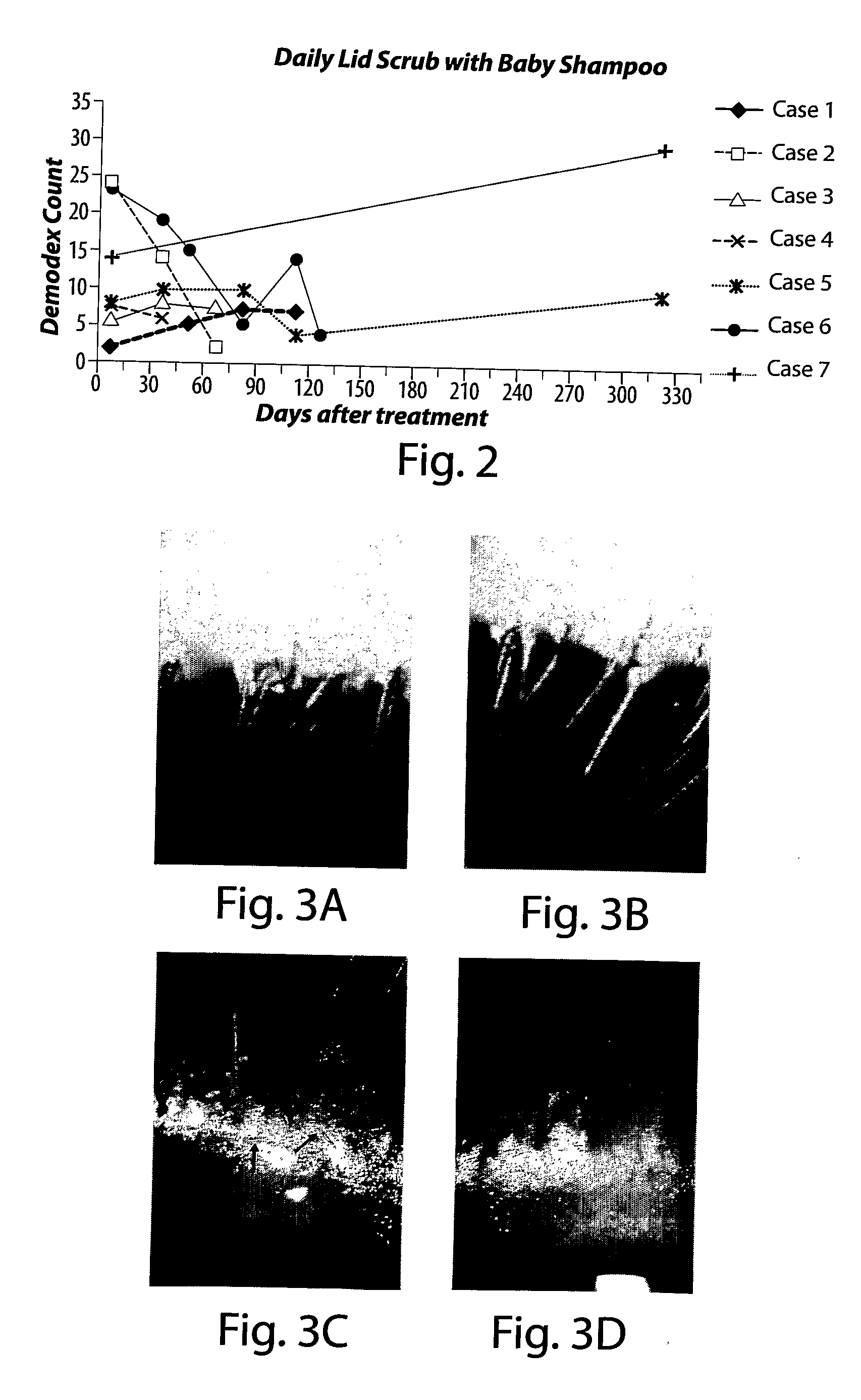 Method for treating ocular demodex